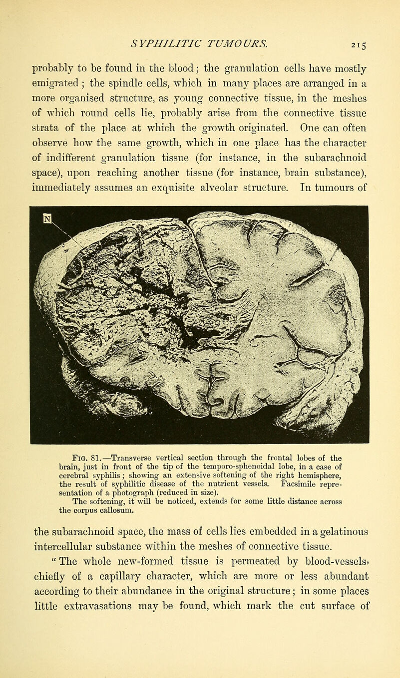 probably to be found in the blood; the granulation cells have mostly emigrated; the spindle cells, which in many places are arranged in a more organised structure, as young connective tissue, in the meshes of which round cells lie, probably arise from the connective tissue strata of the place at which the growth originated. One can often observe how the same growth, which in one place has the character of indifferent granulation tissue (for instance, in the subarachnoid space), upon reaching another tissue (for instance, brain substance), immediately assumes an exquisite alveolar structure. In tumours of FlG. 81.—Transverse vertical section through the frontal lobes of the brain, just in front of the tip of the temporo-sphenoidal lobe, in a case of cerebral syphilis; showing an extensive softening of the right hemisphere, the result of syphilitic disease of the nutrient vessels. Facsimile repre- sentation of a photograph (reduced in size). The softening, it will be noticed, extends for some little distance across the corpus callosum. the subarachnoid space, the mass of cells lies embedded in a gelatinous intercellular substance within the meshes of connective tissue.  The whole new-formed tissue is permeated by blood-vessels* chiefly of a capillary character, which are more or less abundant according to their abundance in the original structure; in some places little extravasations may be found, which mark the cut surface of