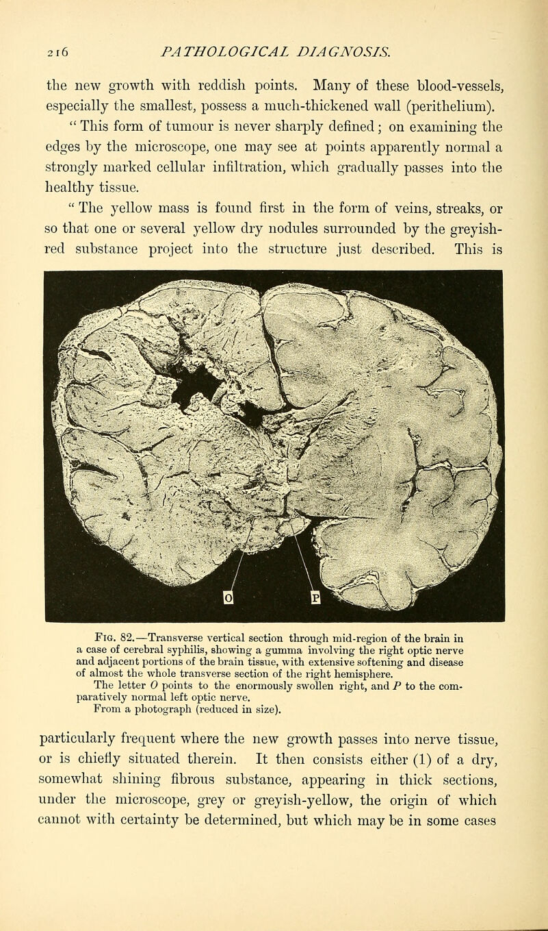 the new growth with reddish points. Many of these blood-vessels, especially the smallest, possess a much-thickened wall (perithelium).  This form of tumour is never sharply defined ; on examining the edges by the microscope, one may see at points apparently normal a strongly marked cellular infiltration, which gradually passes into the healthy tissue.  The yellow mass is found first in the form of veins, streaks, or so that one or several yellow dry nodules surrounded by the greyish- red substance project into the structure just described. This is Fig. 82.—Transverse vertical section through mid-region of the brain in a case of cerebral syphilis, showing a gumma involving the right optic nerve and adjacent portions of the brain tissue, with extensive softening and disease of almost the whole transverse section of the right hemisphere. The letter 0 points to the enormously swollen right, and P to the com- paratively normal left optic nerve. From a photograph (reduced in size). particularly frequent where the new growth passes into nerve tissue, or is chiefly situated therein. It then consists either (1) of a dry, somewhat shining fibrous substance, appearing in thick sections, under the microscope, grey or greyish-yellow, the origin of which cannot with certainty be determined, but which may be in some cases