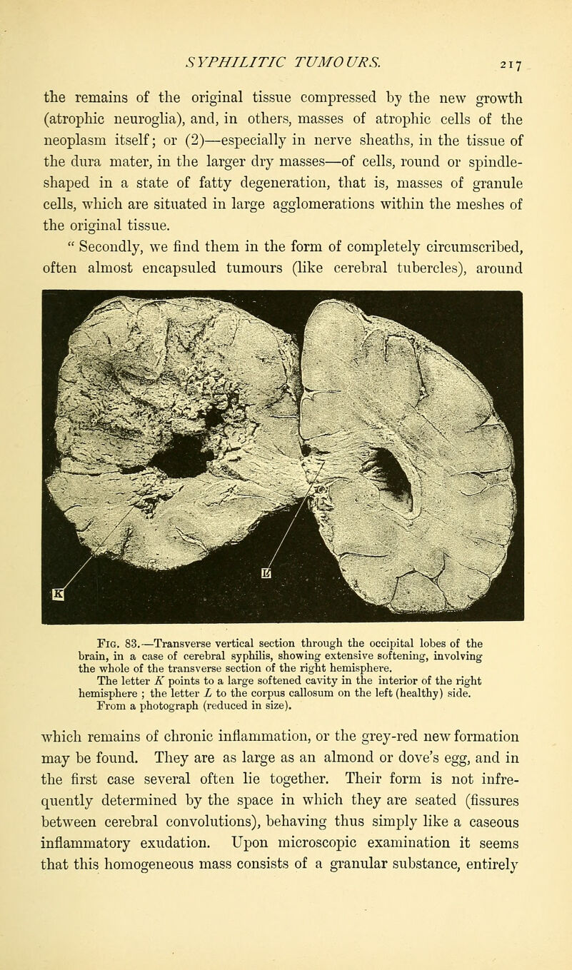 the remains of the original tissue compressed by the new growth (atrophic neuroglia), and, in others, masses of atrophic cells of the neoplasm itself; or (2)—especially in nerve sheaths, in the tissue of the dura mater, in the larger dry masses—of cells, round or spindle- shaped in a state of fatty degeneration, that is, masses of granule cells, which are situated in large agglomerations within the meshes of the original tissue.  Secondly, we find them in the form of completely circumscribed, often almost encapsuled tumours (like cerebral tubercles), around Fig. 83.—Transverse vertical section through the occipital lobes of the brain, in a case of cerebral syphilis, showing extensive softening, involving the whole of the transverse section of the right hemisphere. The letter K points to a large softened cavity in the interior of the right hemisphere ; the letter L to the corpus callosum on the left (healthy) side. From a photograph (reduced in size). which remains of chronic inflammation, or the grey-red new formation may be found. They are as large as an almond or dove's egg, and in the first case several often lie together. Their form is not infre- quently determined by the space in which they are seated (fissures between cerebral convolutions), behaving thus simply like a caseous inflammatory exudation. Upon microscopic examination it seems that this homogeneous mass consists of a granular substance, entirely