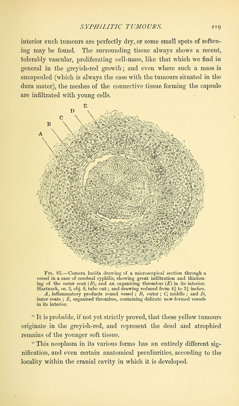 interior such tumours are perfectly dry, or some small spots of soften- ing may be found. The surrounding tissue always shows a recent, tolerably vascular, proliferating cell-mass, like that which we find in general in the greyish-red growth; and even where such a mass is encapsuled (which is always the case with the tumours situated in the dura mater), the meshes of the connective tissue forming the capsule are infiltrated with young cells. Fig. 85.—Camera lucida drawing of a microscopical section through a vessel in a case of cerebral syphilis, showing great infiltration and thicken- ing of the outer coat (£■), and an organising thrombus (E) in its interior. Hartnack, oc. 3, obj. 8, tube out; and drawing reduced from 4^ to 3^ inches. A, inflammatory products round vessel ; B, outer ; C, middle ; and D, inner coats ; E, organised thrombus, containing delicate new-formed vessels in its interior.  It is probable, if not yet strictly proved, that these yellow tumours originate in the greyish-red, and represent the dead and atrophied remains of the younger soft tissue.  This neoplasm in its various forms has an entirely different sig- nification, and even certain anatomical peculiarities, according to the locality within the cranial cavity in which it is developed.