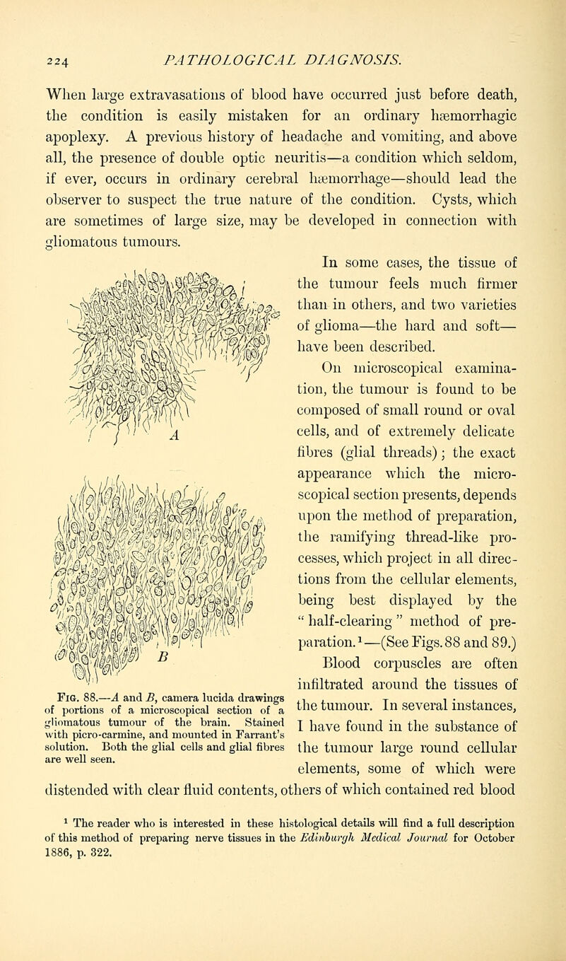 When large extravasations of blood have occurred just before death, the condition is easily mistaken for an ordinary hemorrhagic apoplexy. A previous history of headache and vomiting, and above all, the presence of double optic neuritis—a condition which seldom, if ever, occurs in ordinary cerebral haemorrhage—should lead the observer to suspect the true nature of the condition. Cysts, which are sometimes of large size, may be developed in connection with gliomatous tumours. In some cases, the tissue of the tumour feels much firmer than in others, and two varieties of glioma—the hard and soft— have been described. On microscopical examina- tion, the tumour is found to be composed of small round or oval cells, and of extremely delicate fibres (glial threads); the exact appearance which the micro- scopical section presents, depends upon the method of preparation, the ramifying thread-like pro- cesses, which project in all direc- tions from the cellular elements, being best displayed by the  half-clearing  method of pre- paration.1—(See Figs. 88 and 89.) Blood corpuscles are often infiltrated around the tissues of the tumour. In several instances, I have found in the substance of the tumour large round cellular elements, some of which were distended with clear fluid contents, others of which contained red blood J m Fig. 88.—A and B, camera lucida drawings of portions of a microscopical section of a gliomatous tumour of the brain. Stained with picro-carmine, and mounted in Farrant's solution. Both the glial cells and glial fibres are well seen. 1 The reader who is interested in these histological details will find a full description of this method of preparing nerve tissues in the Edinburgh Medical Journal for October 1886, p. 322.