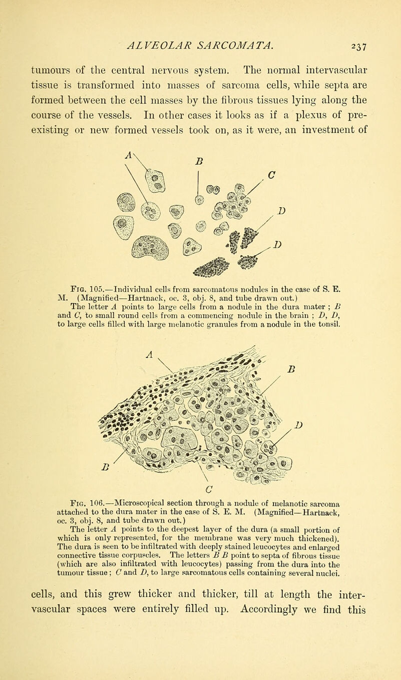 tumours of the central nervous system. The normal intervascular tissue is transformed into masses of sarcoma cells, while septa are formed between the cell masses by the fibrous tissues lying along the course of the vessels. In other cases it looks as if a plexus of pre- existing or new formed vessels took on, as it were, an investment of Fig. 105.—Individual cells from sarcomatous nodules in the case of S. E. M. (Magnified—Hartnack, oc. 3, obj. 8, and tube drawn out.) The letter A points to large cells from a nodule in the dura mater ; B and C, to small round cells from a commencing nodule in the brain ; D, D, to large cells filled with large melanotic granules from a nodule in the tonsil. Fig. 106.—Microscopical section through a nodule of melanotic sarcoma attached to the dura mater in the case of S. E. M. (Magnified—Hartnack, oc. 3, obj. 8, and tube drawn out.) The letter A points to the deepest layer of the dura (a small portion of which is only represented, for the membrane was very much thickened). The dura is seen to be infiltrated with deeply stained leucocytes and enlarged connective tissue corpuscles. The letters B B point to septa of fibrous tissue (which are also infiltrated with leucocytes) passing from the dura into the tumour tissue; 0 and D, to large sarcomatous cells containing several nuclei. cells, and this grew thicker and thicker, till at length the inter- vascular spaces were entirely filled up. Accordingly we find this