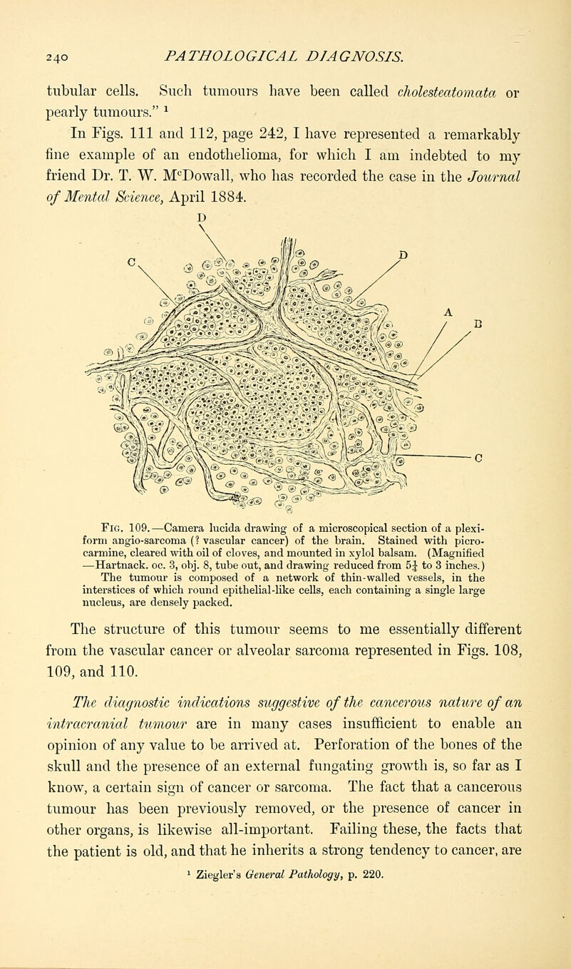 tubular cells. Such tumours have been called cholesteatomata or pearly tumours. 1 In Figs. Ill and 112, page 242, I have represented a remarkably fine example of an endothelioma, for which I am indebted to my friend Dr. T. W. McDowall, who has recorded the case in the Journal of Mental Science, April 1884. D Fig. 109.—Camera lucida drawing of a microscopical section of a plexi- form angio-sarcoma (? vascular cancer) of the brain. Stained with picro- carmine, cleared with oil of cloves, and mounted in xylol balsam. (Magnified —Hartnack. oc. 3, obj. 8, tube out, and drawing reduced from 5£ to 3 inches.) The tumour is composed of a network of thin-walled vessels, in the interstices of which round epithelial-like cells, each containing a single large nucleus, are densely packed. The structure of this tumour seems to me essentially different from the vascular cancer or alveolar sarcoma represented in Figs. 108, 109, and 110. The diagnostic indications suggestive of the cancerous nature of an intracranial tumour are in many cases insufficient to enable an opinion of any value to be arrived at. Perforation of the bones of the skull and the presence of an external fungating growth is, so far as I know, a certain sign of cancer or sarcoma. The fact that a cancerous tumour has been previously removed, or the presence of cancer in other organs, is likewise all-important. Failing these, the facts that the patient is old, and that he inherits a strong tendency to cancer, are 1 Ziegler's General Pathology, p. 220.