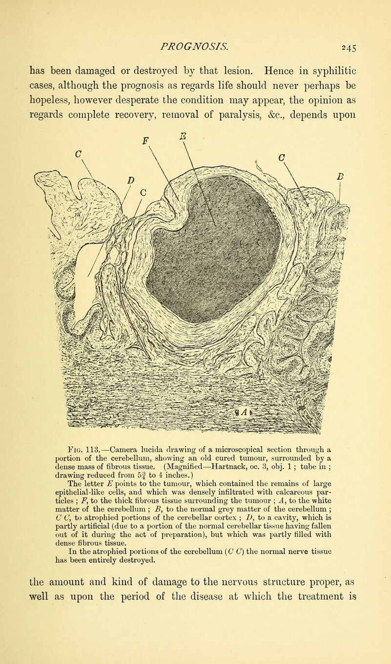 PROGNOSIS. has been damaged or destroyed by that lesion. Hence in syphilitic cases, although the prognosis as regards life should never perhaps be hopeless, however desperate the condition may appear, the opinion as regards complete recovery, removal of paralysis, &c, depends upon Fig. 113.—Camera lucida drawing of a microscopical section through a portion of the cerebellum, showing an old cured tumour, surrounded by a dense mass of fibrous tissue. (Magnified—Hartnack, oc. 3, obj. 1; tube in ; drawing reduced from 5f to 4 inches.) The letter E points to the tumour, which contained the remains of large epithelial-like cells, and which was densely infiltrated with calcareous par- ticles ; F, to the thick fibrous tissue surrounding the tumour ; A, to the white matter of the cerebellum ; B, to the normal grey matter of the cerebellum ; C C, to atrophied portions of the cerebellar cortex ; D, to a cavity, which is partly artificial (due to a portion of the normal cerebellar tissue having fallen out of it during the act of preparation), but which was partly filled with dense fibrous tissue. In the atrophied portions of the cerebellum (0 C) the normal nerve tissue has been entirely destroyed. the amount and kind of damage to the nervous structure proper, as well as upon the period of the disease at which the treatment is