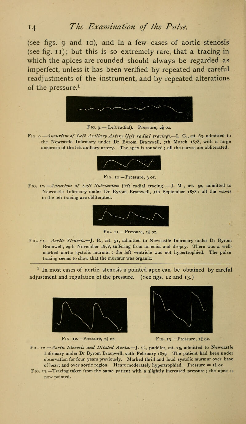 (see figs. 9 and 10), and in a few cases of aortic stenosis (see fig. 11); but this is so extremely rare, that a tracing in which the apices are rounded should always be regarded as imperfect, unless it has been verified by repeated and careful readjustments of the instrument, and by repeated alterations of the pressure.^ Fig. 9.—(Left radial). Pressure, 25 oz. Fig. 9 —Aneurism of Left Axillary Artery {left radial tracing).—L G., set. 63, admitted to the Newcastle Infirmary under Dr Byrom Bramwell, 7th March 1878, with a large aneurism of the left axillary artery. The apex is rounded ; all the curves are obliterated. Pressure, 3 oz. Fig. 10,—Aneurism of Left Subclavian (left radial tracing).—J. M , set. 50, admitted to Newcastle Infinnary under Dr Byrom Bramwell, 5th September 1878 : all the waves in the left tracing are obliterated. Fig. II.—Pressure, ij oz. Fig. ic.—Aortic Stenosis.—J. B., aet. 51, admitted to Newcastle Infirmary under Dr Byrom Bramwell, 29th November 1878, suffering from ansemia and dropsy. There was a well- marked aortic systolic murmur; the left ventricle was not hjpertrophied. The pulse tracing seems to show that the murmur was organic. ' In most cases of aortic stenosis a pointed apex can be obtained by careful adjustment and regulation of the pressure. (See figs. 12 and 13.) Fig 12.—Pressure, \\ oz. Fig. 13—Pressure, 2I oz. Fig 12 —Aortic Stenosis and Dilated Aorta.—J. C., puddler, set. 25, admitted to Newcastle Infirmary under Dr Byrom Bramwell, 20th February 1879 The patient had been under observation for four years previously. Marked thrill and loud systolic murmur over base of heart and over aortic region. Heart moderately hypertrophied. Pressure = i^ oz. FiG. 13.—Tracing taken from the same patient with a slightly increased pressure ; the apex is now pointed.