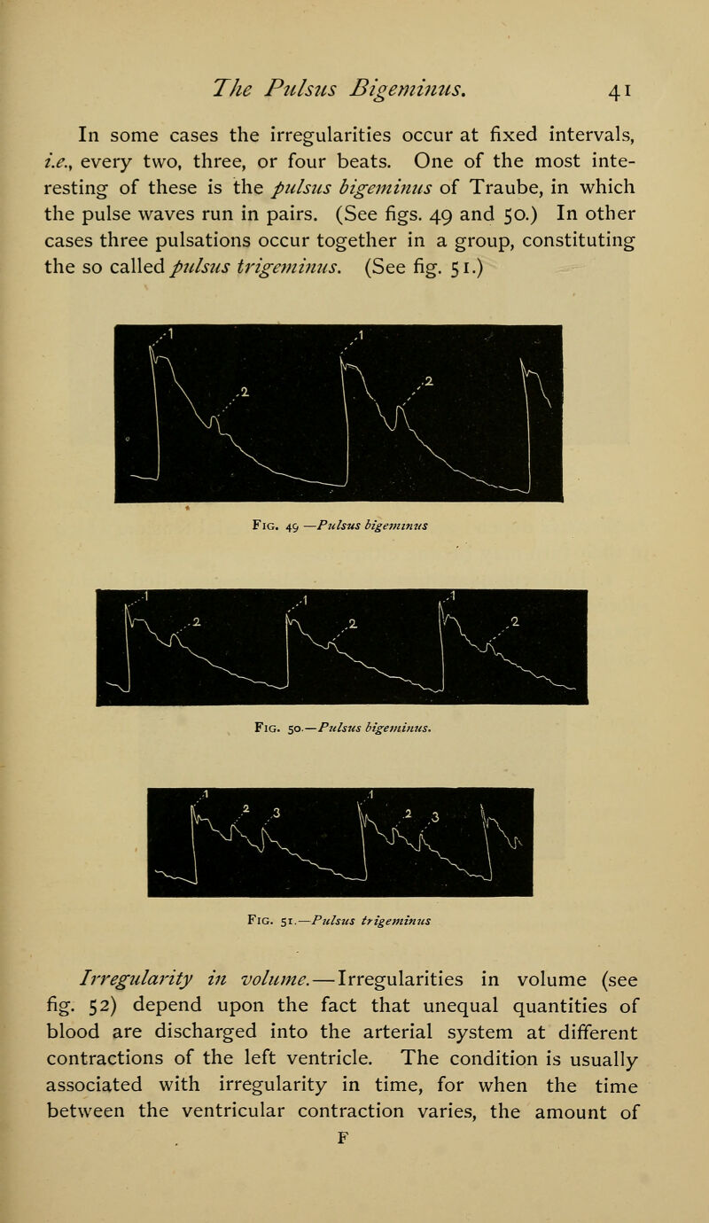 In some cases the irregularities occur at fixed intervals, i.e., every two, three, or four beats. One of the most inte- resting of these is the pulsus bigeminus of Traube, in which the pulse waves run in pairs. (See figs. 49 and 50.) In other cases three pulsations occur together in a group, constituting the so zdXX^^ pulsus trigemimis. (See fig. 51.) Fig. 49 —Pulsus bigetmmis Fig. 50.—Pulsus bigevtmus. Fig. si.—Pulsus trigeminus Irregularity in volume. — Irregularities in volume (see fig. 52) depend upon the fact that unequal quantities of blood are discharged into the arterial system at different contractions of the left ventricle. The condition is usually associated with irregularity in time, for when the time between the ventricular contraction varies, the amount of F