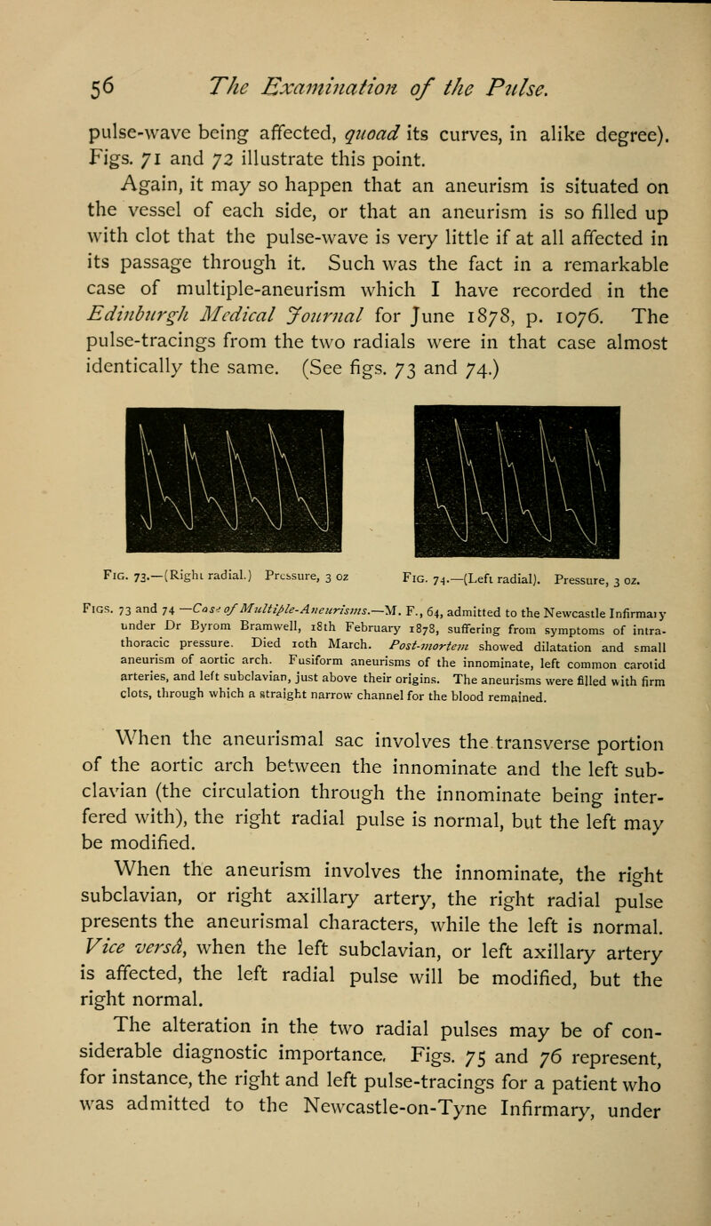 pulse-wave being affected, quoad its curves, in alike degree). Figs. 71 and jz illustrate this point. Again, it may so happen that an aneurism is situated on the vessel of each side, or that an aneurism is so filled up with clot that the pulse-wave is very little if at all affected in its passage through it. Such was the fact in a remarkable case of multiple-aneurism which I have recorded in the Edinburgh Medical Journal for June 1878, p. 1076. The pulse-tracings from the two radials were in that case almost identically the same. (See figs. 73 and 74.) Fig. 73.—(Right radial.) Pressure, 3 oz Fig. 74.—(Lefi radial). Pressure, 3 oz. Figs. 73 and 74 —Cos-; 0/Multiple-Avetirhms.—^. F., 64, admitted to the Newcastle Infirmaiy under Dr Byrom Bramwell, 18th February 1878, suffering from symptoms of intra- thoracic pressure. Died loth March. Post-mortem showed dilatation and small aneurism of aortic arch. Fusiform aneurisms of the innominate, left common carotid arteries, and left subclavian, just above their origins. The aneurisms were filled with firm clots, through which a straight narrow channel for the blood remained. When the aneurismal sac involves the transverse portion of the aortic arch between the innominate and the left sub- clavian (the circulation through the innominate being inter- fered with), the right radial pulse is normal, but the left may be modified. When the aneurism involves the innominate, the right subclavian, or right axillary artery, the right radial pulse presents the aneurismal characters, while the left is normal. Vice versa, when the left subclavian, or left axillary artery is afifected, the left radial pulse will be modified, but the right normal. The alteration in the two radial pulses may be of con- siderable diagnostic importance. Figs. 75 and ^6 represent, for instance, the right and left pulse-tracings for a patient who was admitted to the Newcastle-on-Tyne Infirmary, under