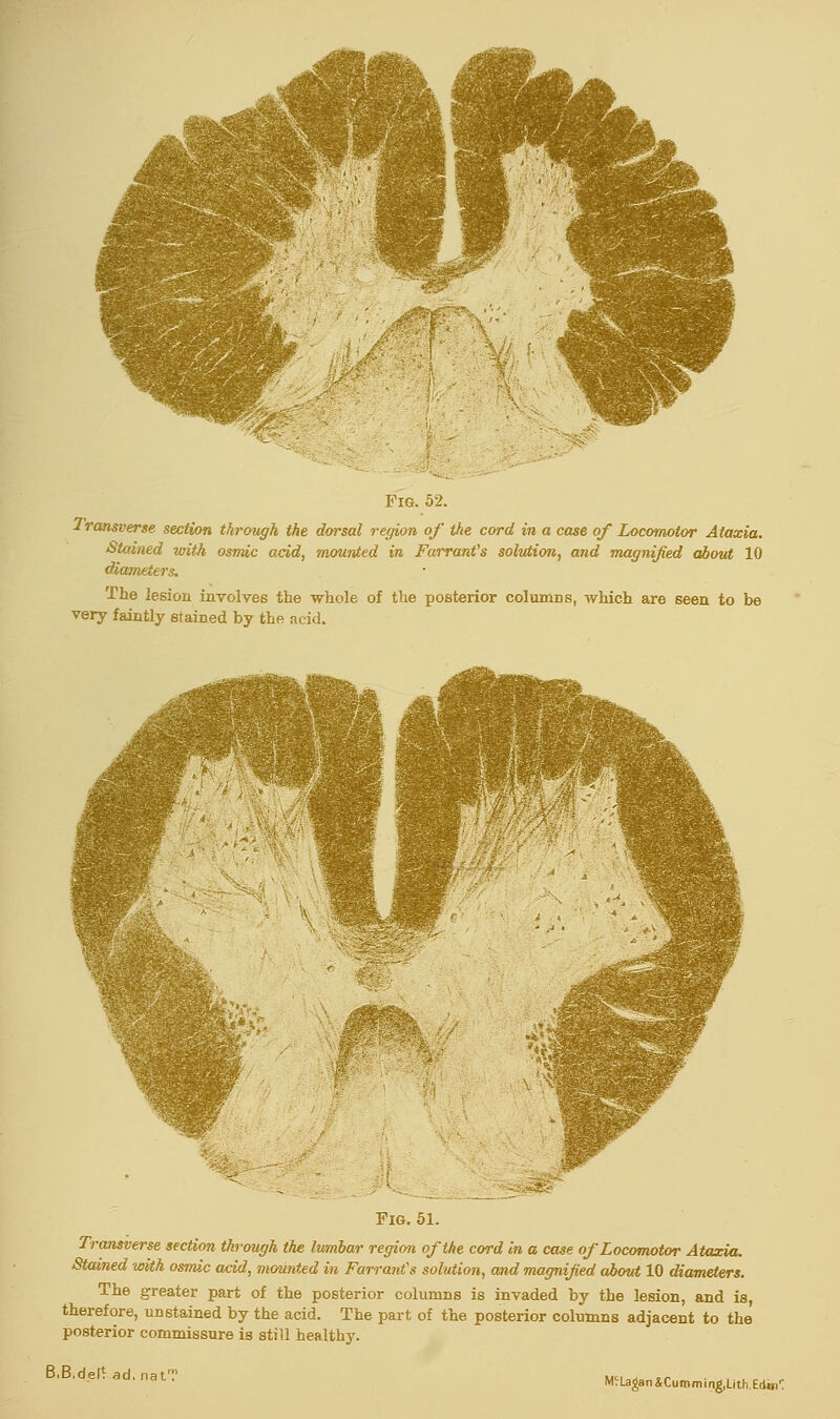 Transverse section through the dorsal region of the cord in a case of Locomotor Ataxia. Stained with osmic acid, mounted in. Farranfs solution, and magnified about 10 diameters. The lesion involves the whole of the posterior columns, which are seen to be very faintly stained by the acid. Fig. 51. Transverse section through the lumbar region of the cord in a case of Locomotor Ataxia. Stained with osmic acid, mounted in Farranfs solution, and magnified about 10 diameters. The greater part of the posterior columns is invaded by the lesion, and is, therefore, unstained by the acid. The part of the posterior columns adjacent to the posterior commissure is still healthy. B.B.del* ad. nat?