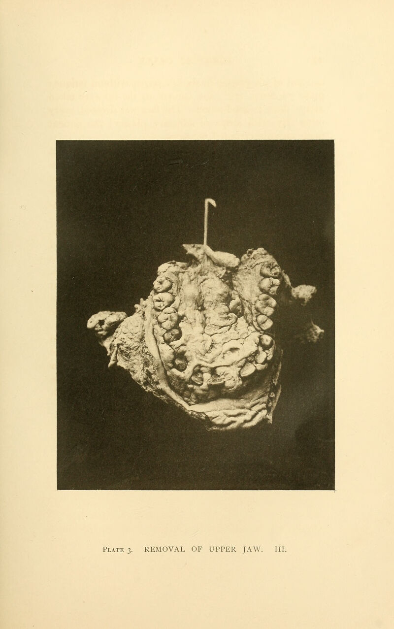 Plates- REMOVAL OF UPPER JAW. III.