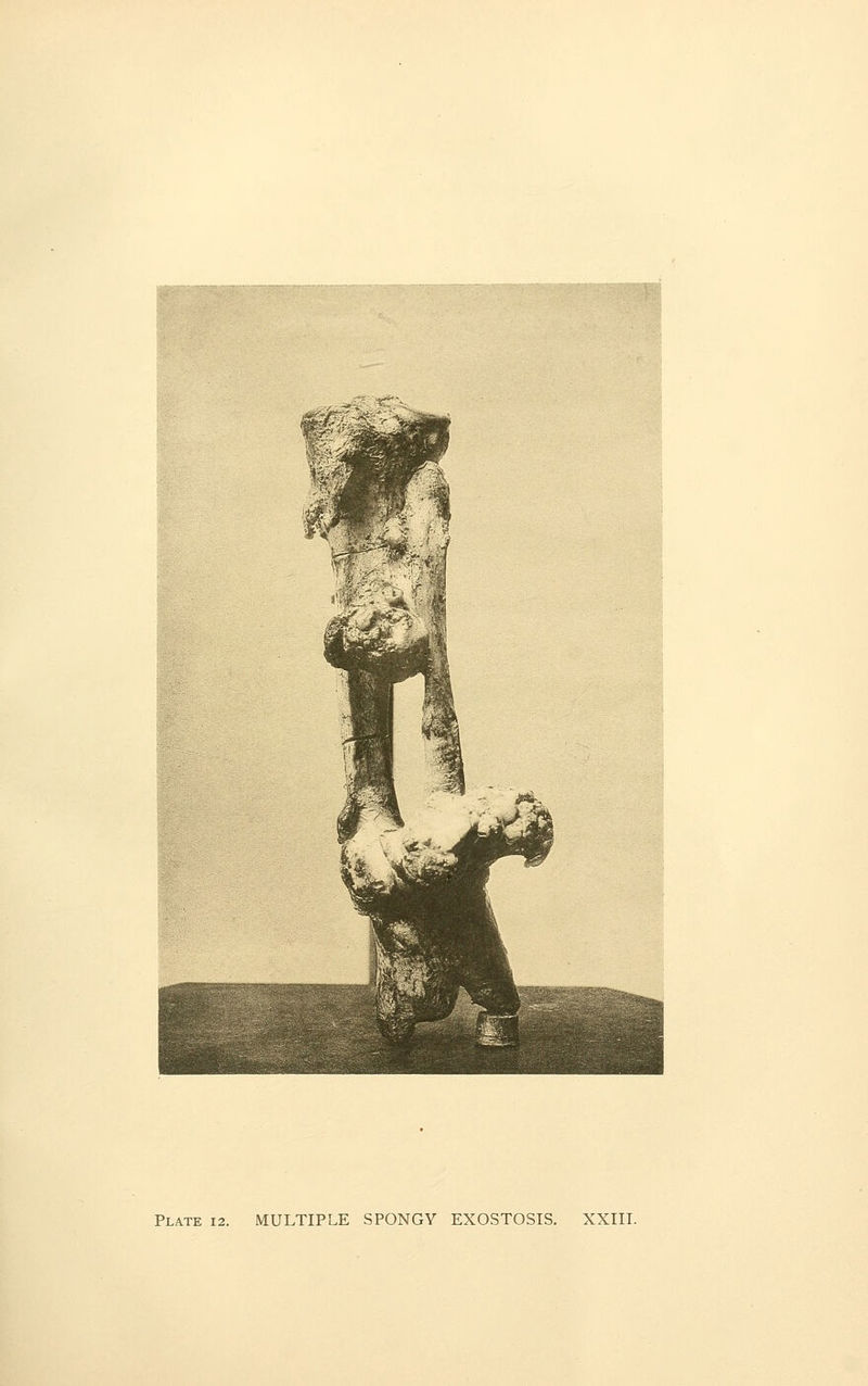 Plate 12. MULTIPLE SPONGY EXOSTOSIS. XXIII.