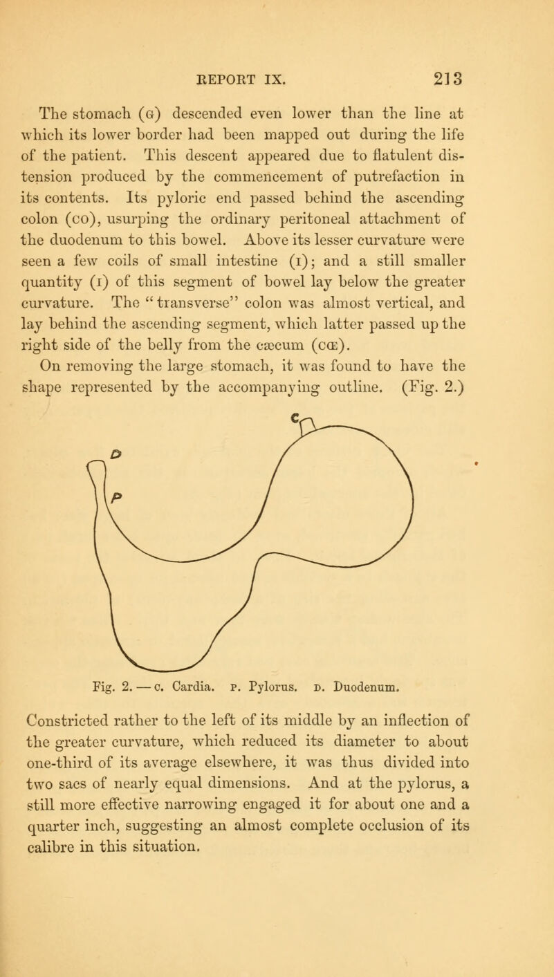 The stomach (g) descended even lower than the line at which its lower border had been mapped out during the life of the patient. This descent appeared due to flatulent dis- tension produced by the commencement of putrefaction in its contents. Its pyloric end passed behind the ascending colon (co), usurping the ordinary peritoneal attachment of the duodenum to this bowel. Above its lesser curvature were seen a few coils of small intestine (i); and a still smaller quantity (i) of this segment of bowel lay below the greater curvature. The transverse colon was almost vertical, and lay behind the ascending segment, which latter passed up the right side of the belly from the caecum (c(e). On removing the large stomach, it was found to have the shape represented by the accompanying outline. (Fig. 2.) Fig. 2. — c. Cardia. p. Pylorus, d. Duodenum. Constricted rather to the left of its middle by an inflection of the greater curvature, which reduced its diameter to about one-third of its average elsewhere, it was thus divided into two sacs of nearly equal dimensions. And at the pylorus, a still more effective narrowing engaged it for about one and a quarter inch, suggesting an almost complete occlusion of its calibre in this situation.