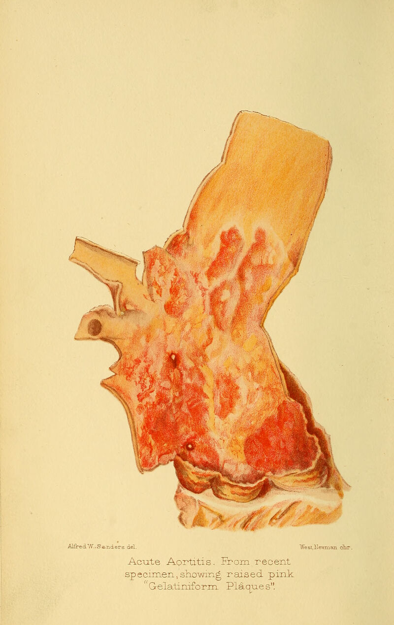 AliredTy\r..Sa.nders del. West,llewman chr. Acute Aortitis. From recent specimen,showing raised pink 'Gelatiniform Plaques.