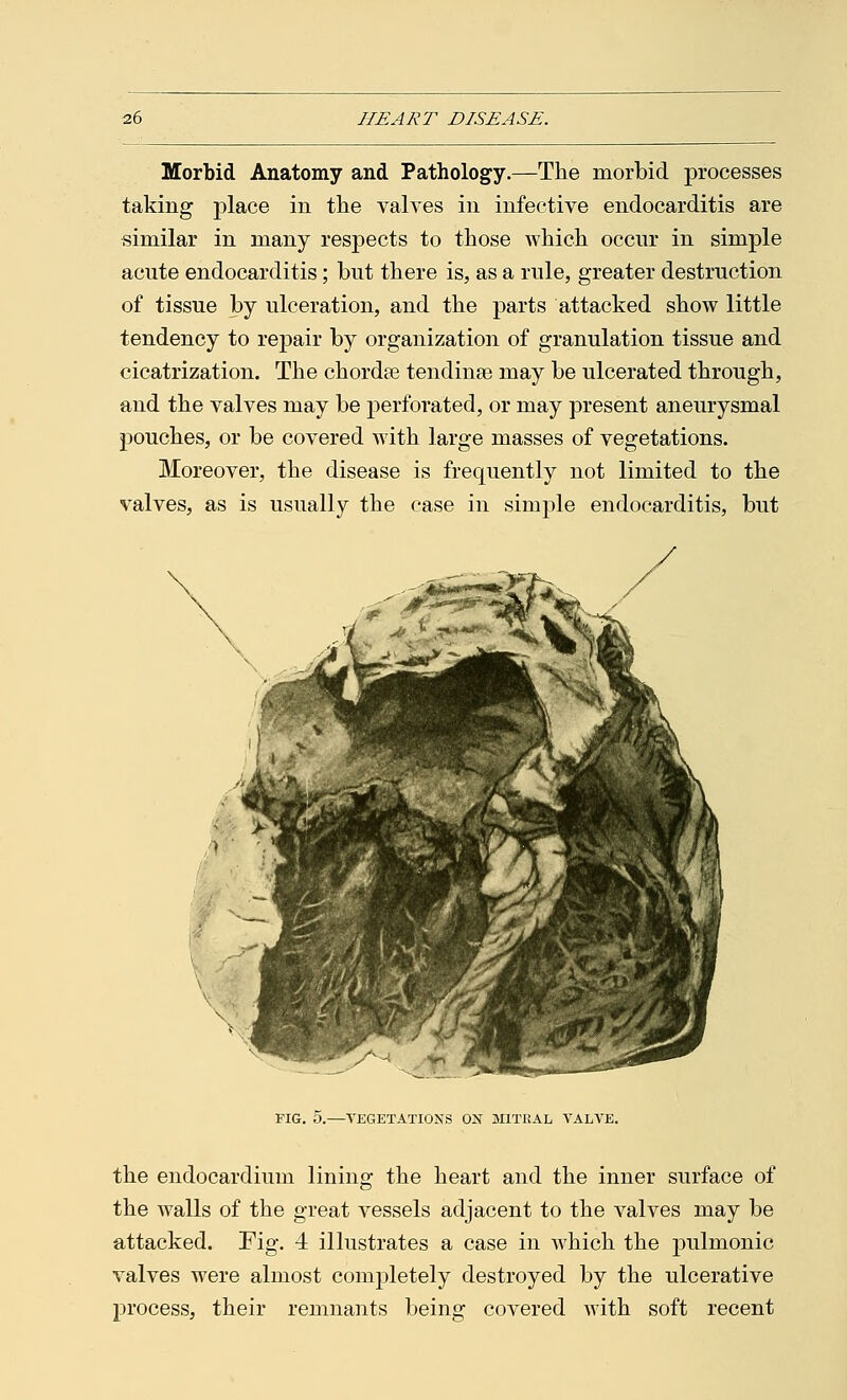 Morbid Anatomy and Pathology.—The morbid processes taking place in the valves in infective endocarditis are similar in many respects to those which occur in simple acute endocarditis; but there is, as a rule, greater destruction of tissue by ulceration, and the parts attacked show little tendency to repair by organization of granulation tissue and cicatrization. The chordse tendinse may be ulcerated through, and the valves may be perforated, or may present aneurysmal pouches, or be covered with large masses of vegetations. Moreover, the disease is frequently not limited to the valves, as is usually the case in simple endocarditis, but FIG. 5.—VEGETATIONS ON MITRAL VALVE. the endocardium lining the heart and the inner surface of the walls of the great vessels adjacent to the valves may be attacked. Fig. 4 illustrates a case in which the pulmonic valves were almost completely destroyed by the ulcerative process, their remnants being covered with soft recent