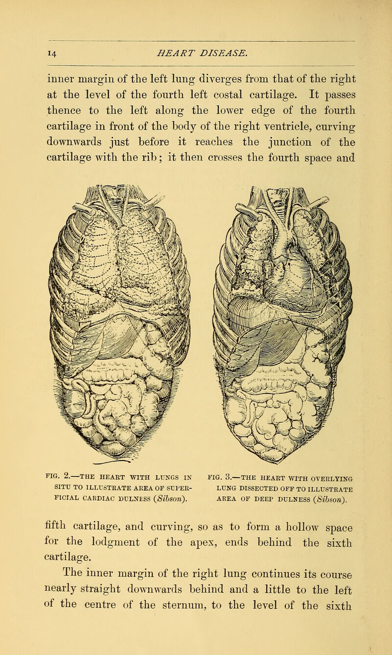 inner margin of the left lung diverges from that of the right at the level of the fourth left costal cartilage. It passes thence to the left along the lower edge of the fourth cartilage in front of the body of the right ventricle, curving downwards just before it reaches the junction of the cartilage with the rib; it then crosses the fourth space and FIG. 2.—THE HEART WITH LUNGS IN SITU TO ILLUSTRATE AREA OF SUPER- FICIAL CARDIAC DULNESS (Sibsori). FIG. 3.—THE HEART WITH OVERLYING LUNG DISSECTED OFF TO ILLUSTRATE AREA OF DEEP DULNESS (Sibson). fifth cartilage, and curving, so as to form a hollow space for the lodgment of the apex, ends behind the sixth cartilage. The inner margin of the right lung continues its course nearly straight downwards behind and a little to the left of the centre of the sternum, to the level of the sixth