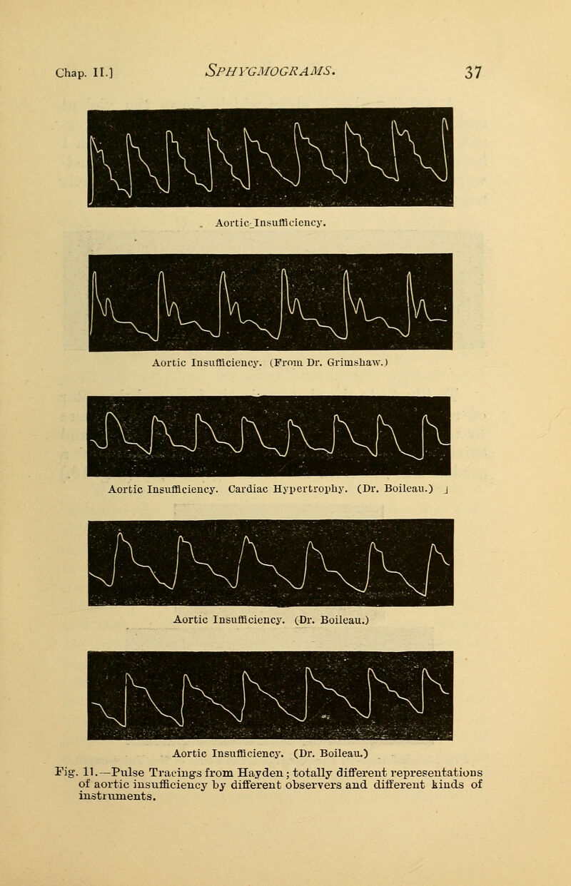 Aorticilnsufflciency. Aortic Insufficiency. (From Di: Grimsliaw.) Aortic Insufficiency. Cardiac Hypertrophy. (Dr. Bolleau.) j Aortic Insufficiency. (Dr. Boileau.) Aortic Insufficiency. (Dr. Boileau.) Fig. 11.—Pulse Traeiugs from Hayden; totally different representations of aortic insufficiency by different observers and different kinds of instruments.