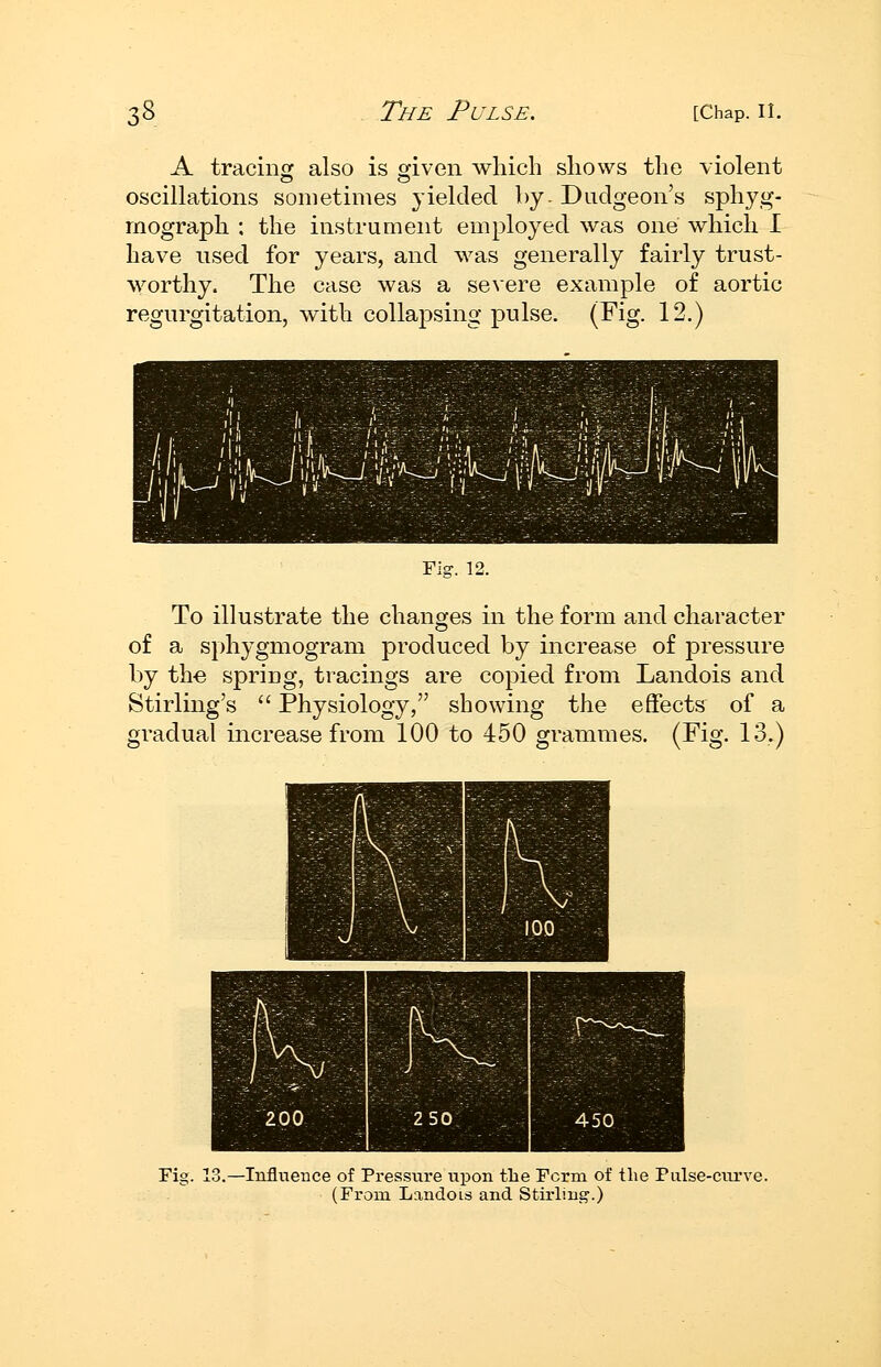 A tracinof also is ojiven which shows the violent oscillations sometimes yielded hy- Dudgeon's sphyg- mograph : the instrument employed was one which I have used for years, and was generally fairly trust- worthy. The case was a severe example of aortic regurgitation, with collapsing pulse. (Fig. 12.) Fig. 12. To illustrate the changes in the form and character of a sphygmogram produced by increase of jDressure by th-e spring, tracings are copied from Landois and Stirling's  Physiology, showing the effects of a gradual increase from 100 to 450 grammes. (Fig. 13.) Fig. 13.—Infliieuce of Pressure upon the Form of the ralse-curv( (From Landois and Stirhng.)