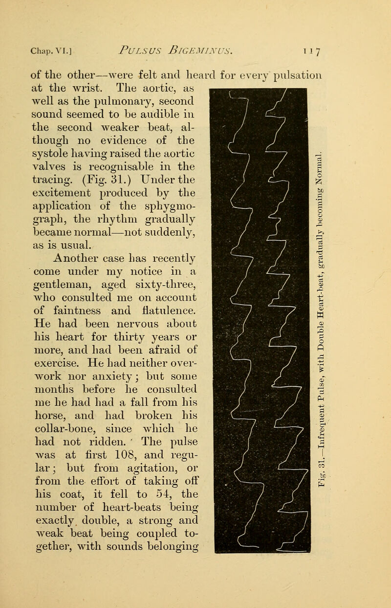 of the other—were felt and heard for every pulsation at the wrist. The aortic, as well as the pulmonary, second sound seemed to be audible in the second weaker beat, al- though no evidence of the systole having raised the aortic valves is recognisable in the tracing. (Fig. 31.) Und er the excitement produced by the application of the sphygmo- graph, the rhythm gradually became normal—not suddenly, as is usual. Another case has recently come under my notice in a gentleman, aged sixty-three, who consulted me on account of faintness and flatulence. He had been nervous about his heart for thirty years or more, and had been afraid of exercise. He had neither over- work nor anxiety \ but some months before he consulted me he had had a fall from his horse, and had broken his collar-bone, since which he had not ridden. ' The pulse was at first 108, and regu- lar ; but from agitation, or from the effort of taking off his coat, it fell to 54, the number of heart-beats being exactly double, a strong and weak beat being coupled to- gether, with sounds belonging