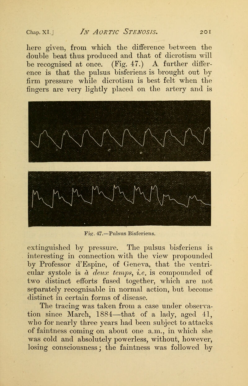 here sfiven, from which the diflference between the double beat thus produced and that of dicrotism will be recognised at once. (Fig. 47.) A further differ- ence is that the pulsus bisferiens is brought out by firm pressure while dicrotism is best felt when the fingers are very lightly placed on the artery and is Pis?. 47.—Pulsus Bisferiens. extinguished by pressure. The pulsus bisferiens is interesting in connection with the view propounded by Professor d'Espine, of Geneva, that the ventri- cular systole is a deux teiii2:)s, i.e. is compounded of two distinct efibrtsr fused together, which are not separately recognisable in normal action, but become distinct in certain forms of disease. The tracing was taken from a case under observa- tion since March, 1884—that of a lady, aged 41, who for nearly three years had been subject to attacks of faintness coming on about one a.m., in which she was cold and absolutely powerless, without, however, losing consciousness; the faintness was followed by