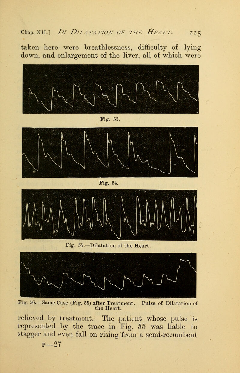 taken here were breatlilessness, clifFiculty of lying down, and enlargement of the liver, all of which Avere Fig. 56. -Same Case (Fig. 55) after Treatment, the Heart. Pulse of Dilatation of relieved by treatment. The .patient whose pulse is represented by the trace in Fig. 55 was liable to stagger and even fall on rising from a semi-recumbent p—27
