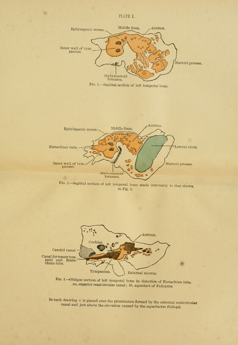 PLATE I. Epitympanic recess.^ MlddleftMsa. .Anti-uni. Inner wall of tym panum. Maetoid proeeos. Stylo-mastol forarnen. Fig. 1.—Sagittal section of left temporal bone. Epity'mpanic recess.\ Middle fossa. Antrum. Eustachian tube. Inner wall of tym panum. Stylo-mastoid forarnen. Latéral sinus. Mastoid process. Fig. 2.-Sagittal section of left temporal bone made interaaUy to that showa in Fig. 1. Carotid canal. Canal for tensor tym- pani and Eusta- chian tube. Antrum. Tympanum. External meatus. Fig. 3.-Oblique section of left temporal bone in direction of Eustachian tube aa, supenor semicircular canal ; bb, aqueduct of Fallopius. In each drawing X la placed over the prominence formed by the external semicircular canal and just above the élévation caused by the aqueduetus Fallopii.