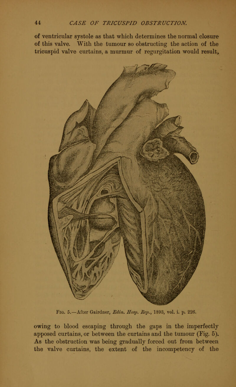 of ventricular systole as that which determines the normal closure of this valve. With the tumour so obstructing the action of the tricuspid valve curtains, a murmur of regurgitation would result, -z-TafiSt. > Fig. 5.—After Gairdner, Edin. Hosj). Jiej)., 1893, vol. i. p. 226. owing to blood escaping through the gaps in the imperfectly apposed curtains, or between the curtains and the tumour (Fig. 5). As the obstruction was being gradually forced out from between the valve curtains, the extent of the incompetency of the