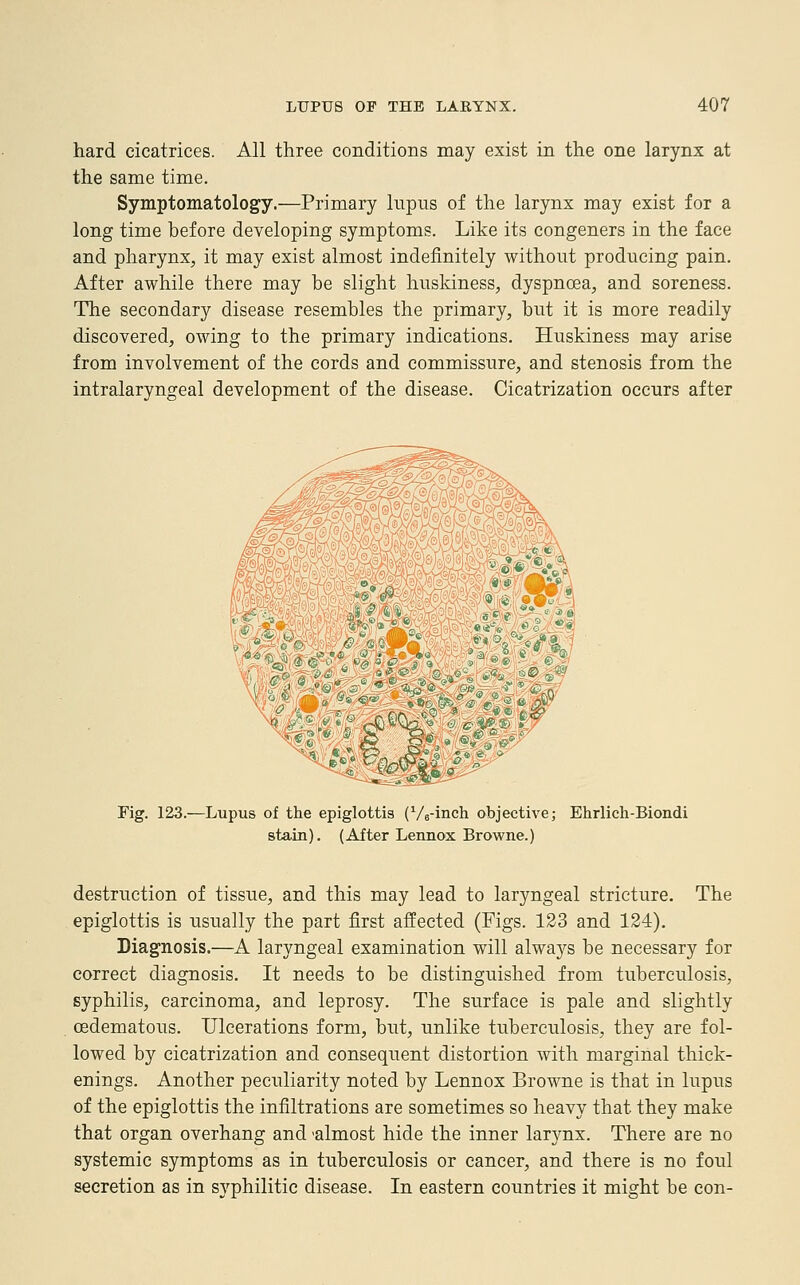 hard cicatrices. All three conditions may exist in the one larynx at the same time. Symptomatology.—Primary lupus of the larynx may exist for a long time before developing symptoms. Like its congeners in the face and pharynx, it may exist almost indefinitely without producing pain. After awhile there may be slight huskiness, dyspnoea, and soreness. The secondary disease resembles the primary, but it is more readily discovered, owing to the primary indications. Huskiness may arise from involvement of the cords and commissure, and stenosis from the intralaryngeal development of the disease. Cicatrization occurs after Fig. 123.—Lupus of the epiglottis (1/a-inch objective; Ehrlich-Biondi stain). (After Lennox Browne.) destruction of tissue, and this may lead to laryngeal stricture. The epiglottis is usually the part first affected (Figs. 123 and 124). Diagnosis.—A laryngeal examination will alwa3^s be necessary for correct diagnosis. It needs to be distinguished from tuberculosis, syphilis, carcinoma, and leprosy. The surface is pale and slightly cedematous. Ulcerations form, but, unlike tuberculosis, they are fol- lowed by cicatrization and consequent distortion with marginal thick- enings. Another peculiarity noted by Lennox Browne is that in lupus of the epiglottis the infiltrations are sometimes so heavy that they make that organ overhang and 'almost hide the inner larynx. There are no systemic symptoms as in tuberculosis or cancer, and there is no foul secretion as in syphilitic disease. In eastern countries it might be con-