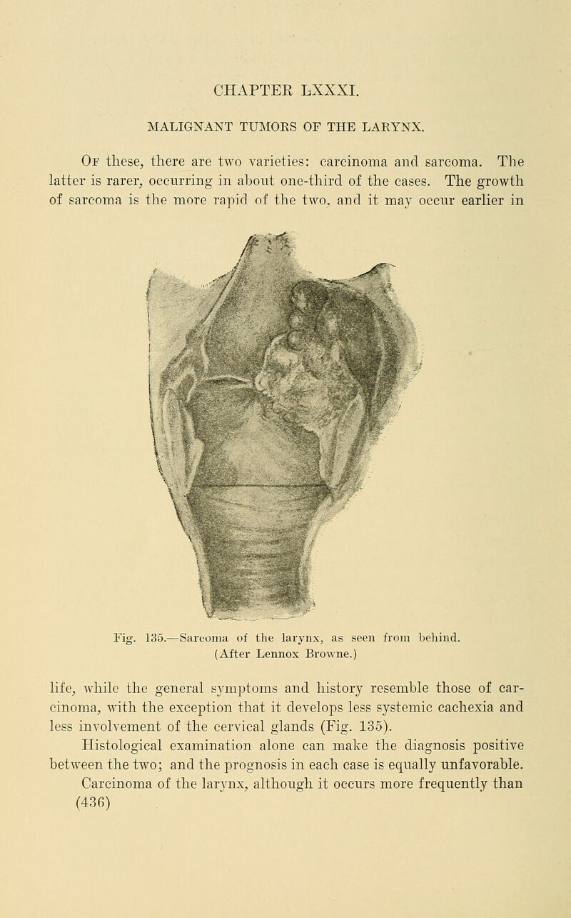 MALIGNANT TUMORS OF THE LARYNX. Or these, there are two varieties: carcinoma and sarcoma. The latter is rarer, occurring in about one-third of the cases. The growth of sarcoma is the more rapid of the two, and it may occur earlier in .''■-. \ Fig. 135.—Sarcoma of the larynx, as seen from behind. (After Lennox Browne.) life, Avhile the general symptoms and history resemble those of car- cinoma, with the exception that it develops less systemic cachexia and less involvement of the cervical glands (Fig. 135). Histological examination alone can make the diagnosis positive between the two; and the prognosis in each case is equally unfavorable. Carcinoma of the larynx, although it occurs more frequently than