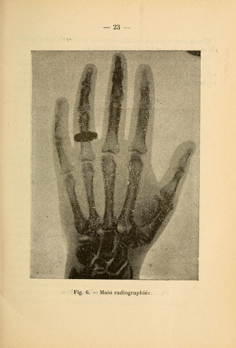 Fig. 6. —: Main radiographiée.