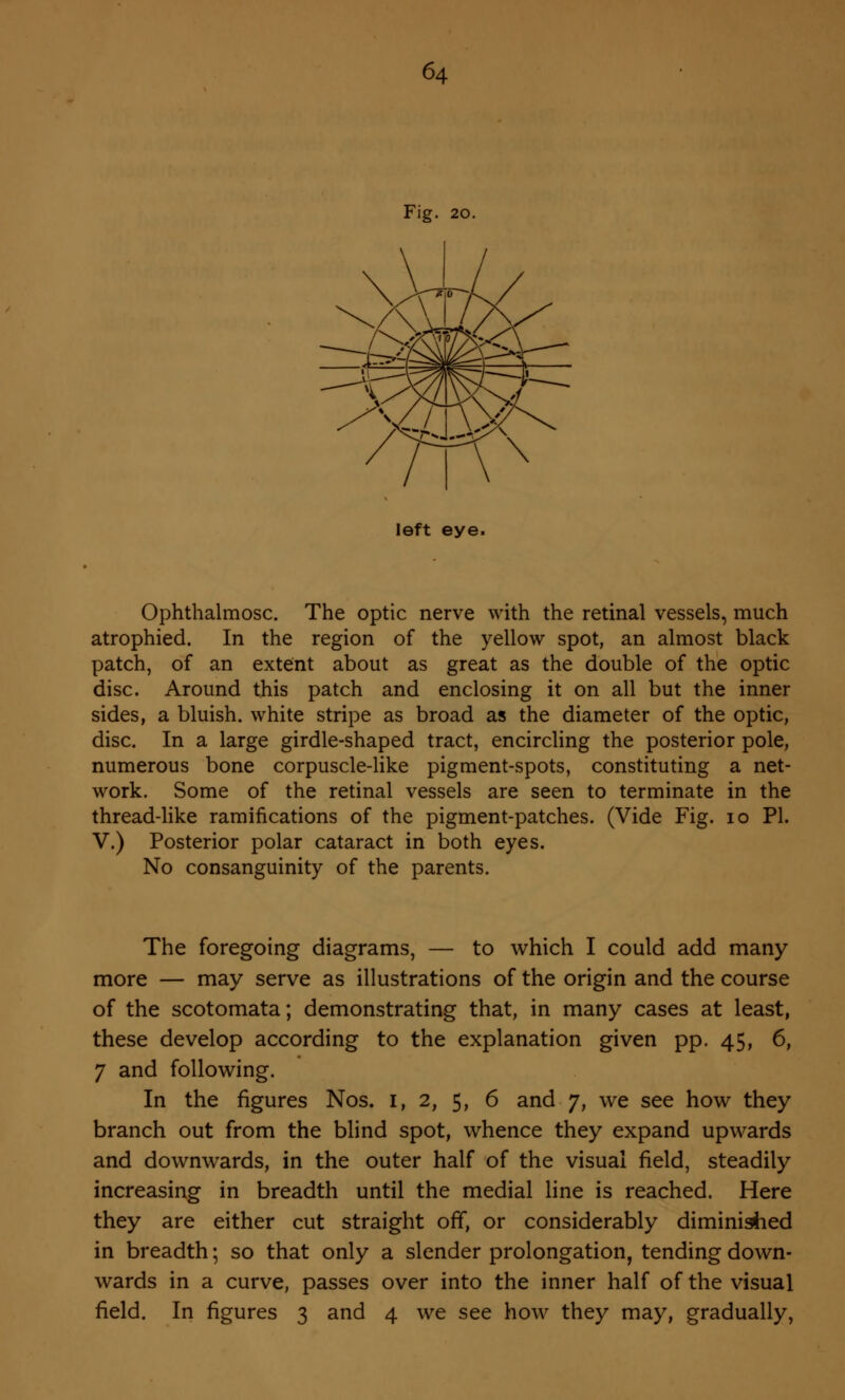 Fig. 20. left eye. Ophthalmosc. The optic nerve with the retinal vessels, much atrophied. In the region of the yellow spot, an almost black patch, of an extent about as great as the double of the optic disc. Around this patch and enclosing it on all but the inner sides, a bluish, white stripe as broad as the diameter of the optic, disc. In a large girdle-shaped tract, encircling the posterior pole, numerous bone corpuscle-like pigment-spots, constituting a net- work. Some of the retinal vessels are seen to terminate in the thread-like ramifications of the pigment-patches. (Vide Fig. 10 PL V.) Posterior polar cataract in both eyes. No consanguinity of the parents. The foregoing diagrams, — to which I could add many more — may serve as illustrations of the origin and the course of the scotomata; demonstrating that, in many cases at least, these develop according to the explanation given pp. 45, 6, 7 and following. In the figures Nos. 1, 2, 5, 6 and 7, we see how they branch out from the blind spot, whence they expand upwards and downwards, in the outer half of the visual field, steadily increasing in breadth until the medial line is reached. Here they are either cut straight off, or considerably diminished in breadth; so that only a slender prolongation, tending down- wards in a curve, passes over into the inner half of the visual field. In figures 3 and 4 we see how they may, gradually,