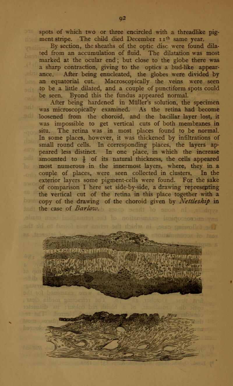 spots of which two or three encircled with a threadlike pig- ment stripe. The child died December ntb same year. By section, the sheaths of the optic disc were found dila- ted from an accumulation of fluid. The dilatation was most marked at the ocular end; but close to the globe there was a sharp contraction, giving to the optics a bud-like appear- ance. After being enucleated, the globes were divided by an equatorial cut. Macroscopically the veins were seen to be a little dilated, and a couple of punctiform spots could be seen. Byond this the fundus appeared normal. After being hardened in Miiller's solution, the specimen was microscopically examined. As the retina had become loosened from the choroid, and the bacillar layer lost, it was impossible to get vertical cuts of both membranes in situ. The retina was in most places found to be normal. In some places, however, it was thickened by infiltrations of small round cells. In corresponding places, the layers ap- peared less distinct. In one place, in which the increase amounted to ^ of its natural thickness, the cells appeared most numerous in the innermost layers, where, they in a couple of places, were seen collected in clusters. In the exterior layers some pigment-cells were found. For the sake of comparison I here set side-by-side, a drawing representing the vertical cut of the retina in this place together with a copy of the drawing of the choroid given by Xettleship in the case of Bark