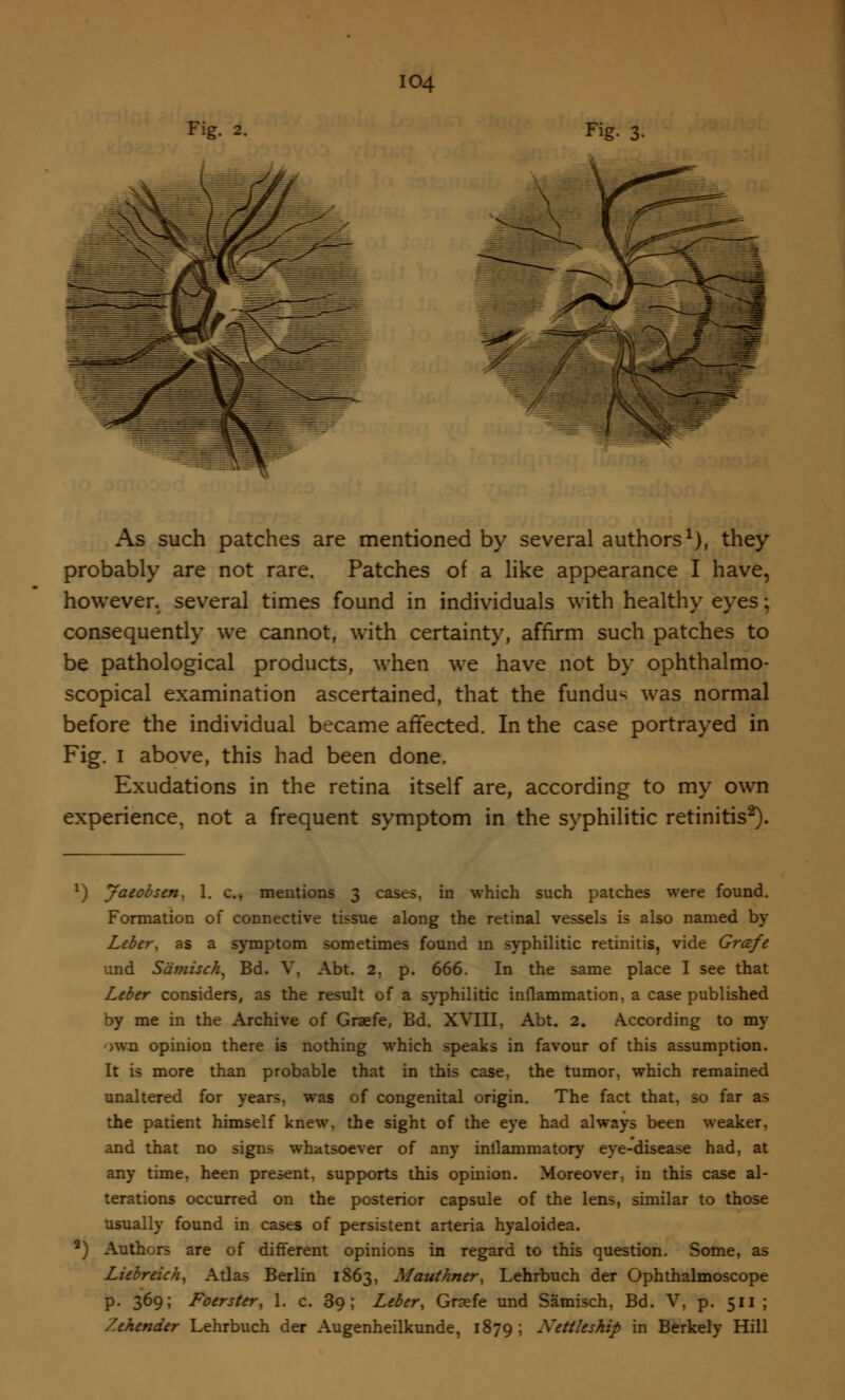 :o4 Fig. As such patches are mentioned by several authors1), they probably are not rare. Patches of a like appearance I have, however, several times found in individuals with healthy eyes; consequently we cannot, with certainty, affirm such patches to be pathological products, when we have not by ophthalmo- scopical examination ascertained, that the fundus was normal before the individual became affected. In the case portrayed in Fig. I above, this had been done. Exudations in the retina itself are, according to my own experience, not a frequent symptom in the syphilitic retinitis2). J) Jacobs en, 1. c, mentions 3 cases, in which such patches were found. Formation of connective tissue along the retinal vessels is also named by Leber, as a symptom sometimes found in syphilitic retinitis, vide Grafe und Samisch, Bd. V, Abt. 2, p. 666. In the same place I see that Leber considers, as the result of a syphilitic inflammation, a case published by me in the Archive of Graefe, Bd. XVIII, Abt. 2. According to my >WD opinion there is nothing which speaks in favour of this assumption. It is more than probable that in this case, the tumor, which remained unaltered for years, was of congenital origin. The fact that, so far as the patient himself knew, the sight of the eye had always been weaker, and that no signs whatsoever of any inflammatory eye-disease had, at any time, heen present, supports this opinion. Moreover, in this case al- terations occurred on the posterior capsule of the lens, similar to those usually found in cases of persistent arteria hyaloidea. 2) Authors are of different opinions in regard to this question. Some, as Liebreich, Atlas Berlin 1863, Mauthner, Lehrbuch der Ophthalmoscope p. 369; Foerster, 1. c. 39; Leber, Graefe und Samisch, Bd. V, p. 511 ; Zehender Lehrbuch der Augenheilkunde, 1879 ; Xettleship in Berkely Hill