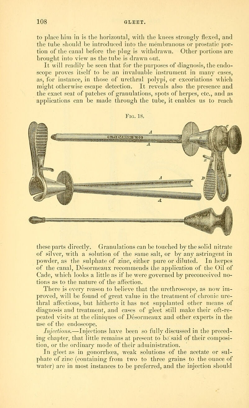 to place him in is the horizontal, with the knees strongly flexed, and the tube should be introduced into the membranous or prostatic por- tion of the canal before the plug is withdrawn. Other portions are brought into view as the tube is drawn ()Ut. It will readily be seen that for the purposes of diagnosis, the endo- scope proves itself to be an invaluable instrument in many cases, as, for instance, in thovSe of urethral polypi, or excoriations which might otherwise escape detection. It reveals also the presence and the exact seat of patches of granulations, spots of herpes, etc., and as applications can be made through the tube, it enables us to reach Fig. 18. these parts directly. Granulations can be touched by the solid nitrate of silver, with a solution of the same salt, or by any astringent in powder, as the sulphate of zinc, either pure or diluted. In herpes of the canal, Desormeaux recommends the application of the Oil of Cade, which looks a little as if he were governed by preconceived no- tions as to the nature of the affection. There is every reason to believe that the urethroscope, as now im- proved, will be found of great value in the treatment of chronic ure- thral affections, but hitherto it has not supplanted other means of diagnosis and treatment, and cases of gleet still make their oft-re- peated visits at the cliniques of Desormeaux and other experts in the use of the endoscope. Injections.—Injections have been so fully discussed in the preced- ing chapter, that little remains at present to be said of their composi- tion, or the ordinary mode of their administration. In gleet as in gonorrhoea, weak solutions of the acetate or sul- phate of zinc (containing from two to three grains to the ounce of water) are in most instances to be preferred, and the injection should