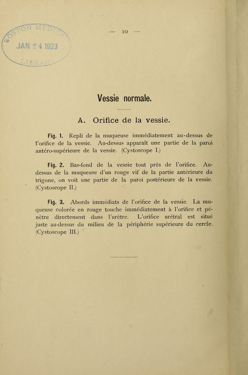 - IO JAN 2 4 ; Vessie normale. A. Orifice de ia vessie. Fig. 1. Repli de la muqueuse immédiatement au-dessus de l'orifice de la vessie. Au-dessus apparaît une partie de la paroi antéro-supérieure de la vessie. (Cystoscope I.) Fig. 2. Bas-fond de la vessie tout près de l'orifice. Au- dessus de la muqueuse d'un rouge vif de la partie antérieure du trigone, on voit une partie de la paroi postérieure de la vessie. (Cystoscope II.) Fig. 3. Abords immédiats de l'orifice de la vessie. La mu- queuse colorée en rouge touche immédiatement à l'orifice et pé- nètre directement dans l'urètre. L'orifice urétral est situé juste au-dessus du milieu de la périphérie supérieure du cercle. (Cystoscope III.)