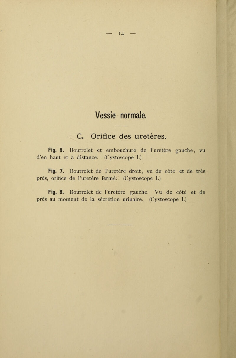 Vessie normale. C. Orifice des uretères. Fig. 6. Bourrelet et embouchure de l'uretère gauche, vu d'en haut et à distance. (Cystoscope I.) Fig. 7. Bourrelet de l'uretère droit, vu de côté et de très, près, orifice de l'uretère fermer (Cystoscope I.) Fig. 8. Bourrelet de l'uretère gauche. Vu de côté et de près au moment de la sécrétion urinaire. (Cystoscope I.)