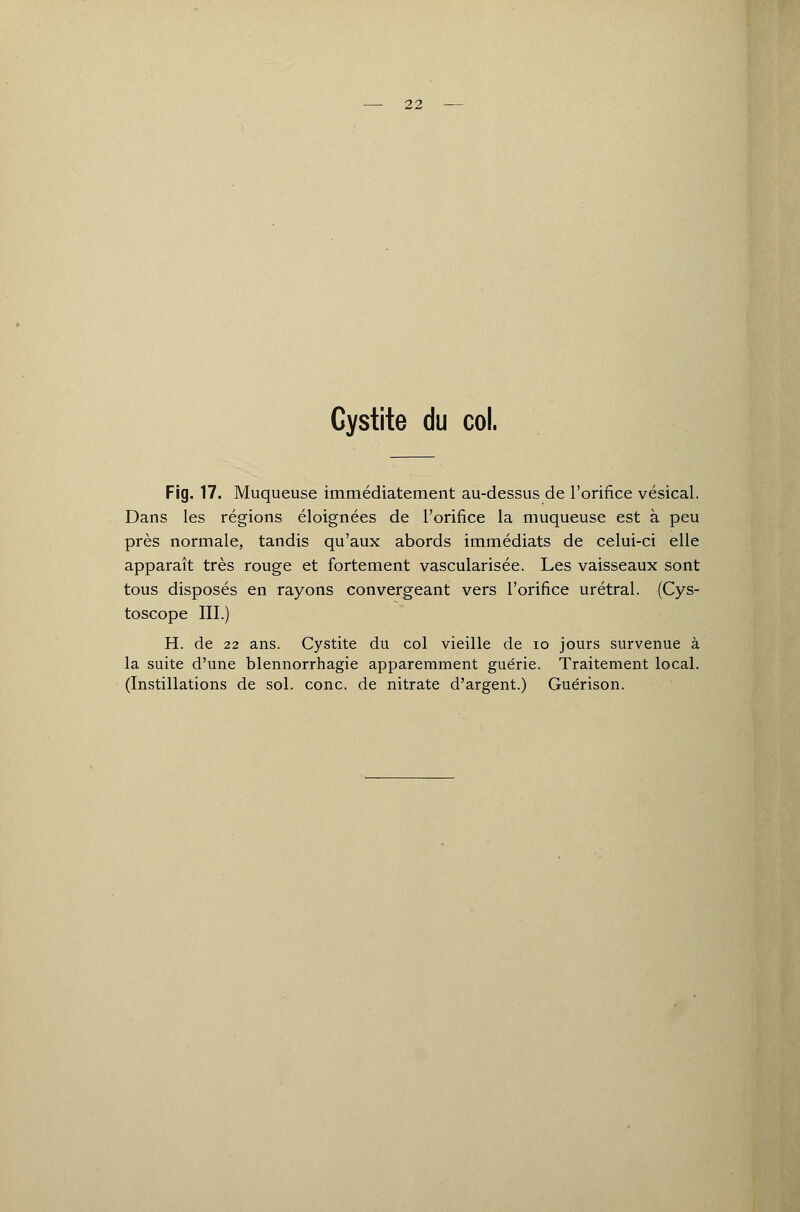 22 Cystite du col. Fig. 17. Muqueuse immédiatement au-dessus de l'orifice vésical. Dans les régions éloignées de l'orifice la muqueuse est à peu près normale, tandis qu'aux abords immédiats de celui-ci elle apparaît très rouge et fortement vascularisée. Les vaisseaux sont tous disposés en rayons convergeant vers l'orifice urétral. (Cys- toscope III.) H. de 22 ans. Cystite du col vieille de io jours survenue à la suite d'une blennorrhagie apparemment guérie. Traitement local. (Instillations de sol. conc. de nitrate d'argent.) Guérison.