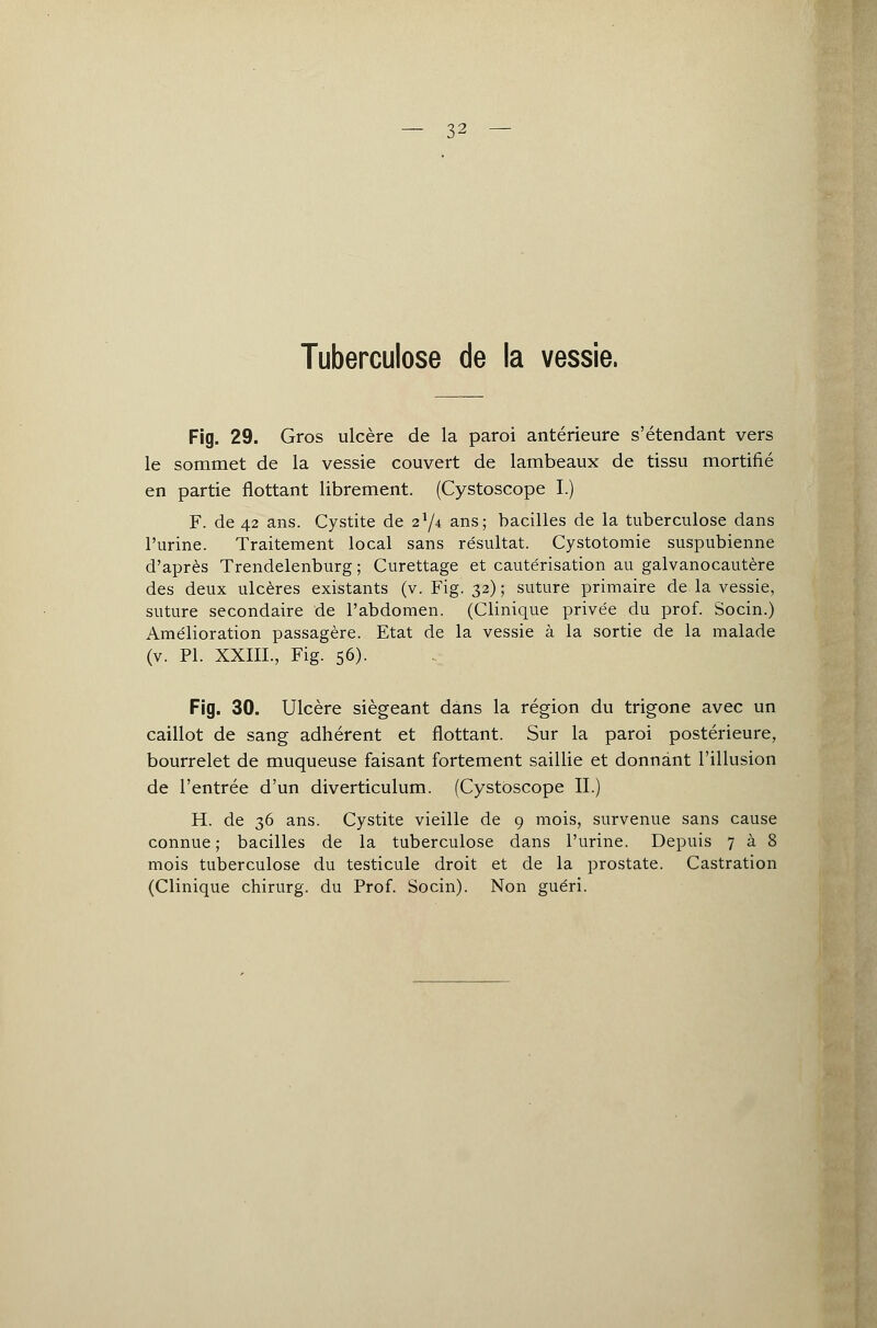 32 — Tuberculose de la vessie. Fig. 29. Gros ulcère de la paroi antérieure s'étendant vers le sommet de la vessie couvert de lambeaux de tissu mortifié en partie flottant librement. (Cystoscope I.) F. de 42 ans. Cystite de 2l/\ ans; bacilles de la tuberculose dans l'urine. Traitement local sans résultat. Cystotomie suspubienne d'après Trendelenburg ; Curettage et cautérisation au galvanocautère des deux ulcères existants (v. Fig. 32) ; suture primaire de la vessie, suture secondaire de l'abdomen. (Clinique privée du prof. Socin.) Amélioration passagère. Etat de la vessie à la sortie de la malade (v. PL XXIII., Fig. 56). Fig. 30. Ulcère siégeant dans la région du trigone avec un caillot de sang adhérent et flottant. Sur la paroi postérieure, bourrelet de muqueuse faisant fortement saillie et donnant l'illusion de l'entrée d'un diverticulum. (Cystoscope IL) H. de 36 ans. Cystite vieille de 9 mois, survenue sans cause connue; bacilles de la tuberculose dans l'urine. Depuis 7 à 8 mois tuberculose du testicule droit et de la prostate. Castration (Clinique chirurg. du Prof. Socin). Non guéri.