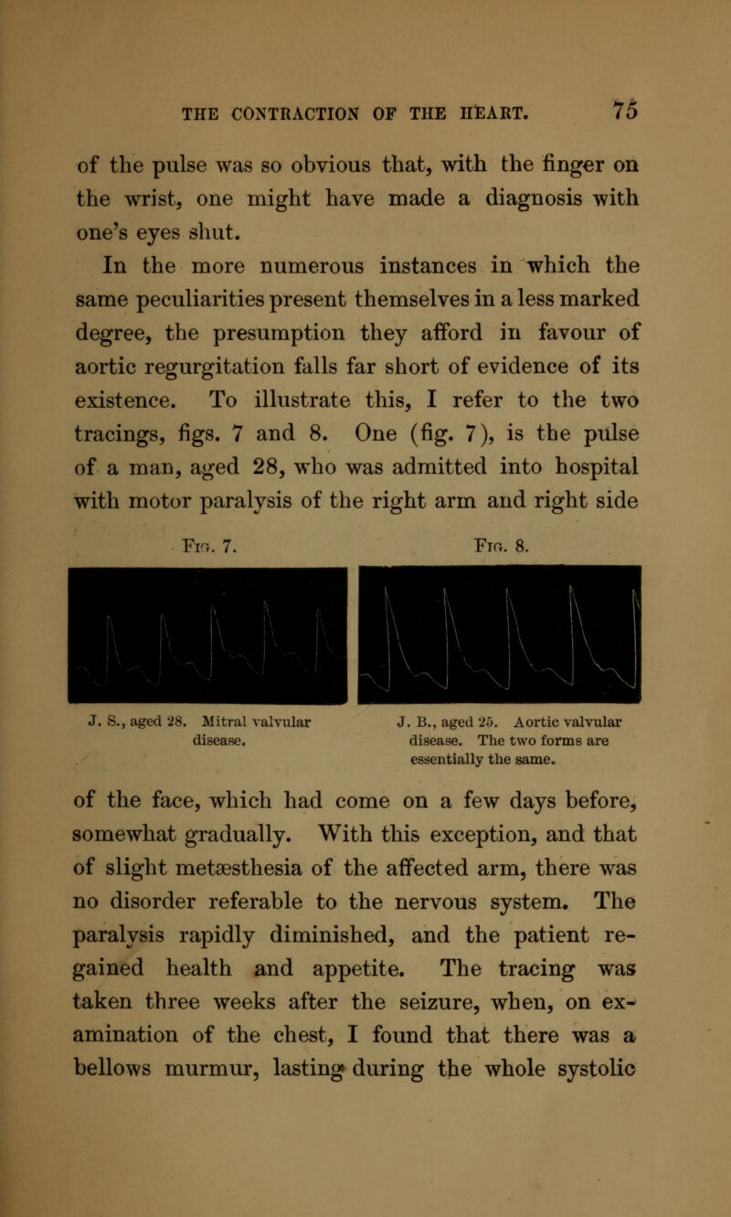 of the pulse was so obvious that, with the finger on the wrist, one might have made a diagnosis with one's eyes shut. In the more numerous instances in which the same peculiarities present themselves in a less marked degree, the presumption they afford in favour of aortic regurgitation falls far short of evidence of its existence. To illustrate this, I refer to the two tracings, figs. 7 and 8. One (fig. 7), is the pulse of a man, aged 28, who was admitted into hospital with motor paralysis of the right arm and right side Fl-r .7. ■ J. S., aged 28. Mitral valvular J. B., aged 25. Aortic valvular disease. disease. The two forms are essentially the same. of the face, which had come on a few days before, somewhat gradually. With this exception, and that of slight metsesthesia of the affected arm, there was no disorder referable to the nervous system. The paralysis rapidly diminished, and the patient re- gained health and appetite. The tracing was taken three weeks after the seizure, when, on ex- amination of the chest, I found that there was a bellows murmur, lasting during the whole systolic