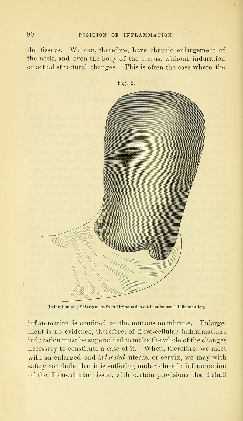the tissues. We can, therefore, have chronic enlargement of the neck, and even the body of the uterus, without induration or actual structural chano-es. This is often the case where the Fig. 2. Induration and Enlargement from fibrinous deposit in submucous inflammation. inflammation is confined to the mucous membrane. Enlarge- ment is no evidence, therefore, of fibro-cellular inflammation; induration must be superadded to make the whole of the changes necessary to constitute a case of it. When, therefore, we meet with an enlarged and indurated uterus, or cervix, we may with safety conclude that it is sufi'ering under chronic inflammation of the fibro-cellular tissue, with certain provisions that I shall