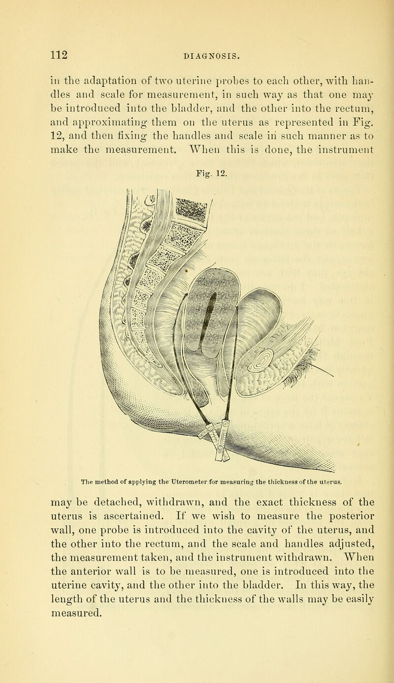 in the adaptation of two uterine probes to each other, with han- dles and scale for measurement, in such way as that one may be introduced into the bLndder, and the other into the rectum, and approximating them on the uterus as represented in Fig. 12, and then fixing the handles and scale iii such manner as to make the measurement. When this is done, the instrument Fig. 12. The method of applying the Uterometer for measuring the thickness of the uterus. may be detached, withdrawn, and the exact thickness of the uterus is ascertained. If we wish to measure the posterior wall, one probe is introduced into the cavity of the uterus, and the other into the rectum, and the scale and handles adjusted, the measurement taken, and the instrument withdrawn. When the anterior wall is to be measured, one is introduced into the uterine cavity, and the other into the bladder. In this way, the length of the uterus and the thickness of the walls may be easily measured.