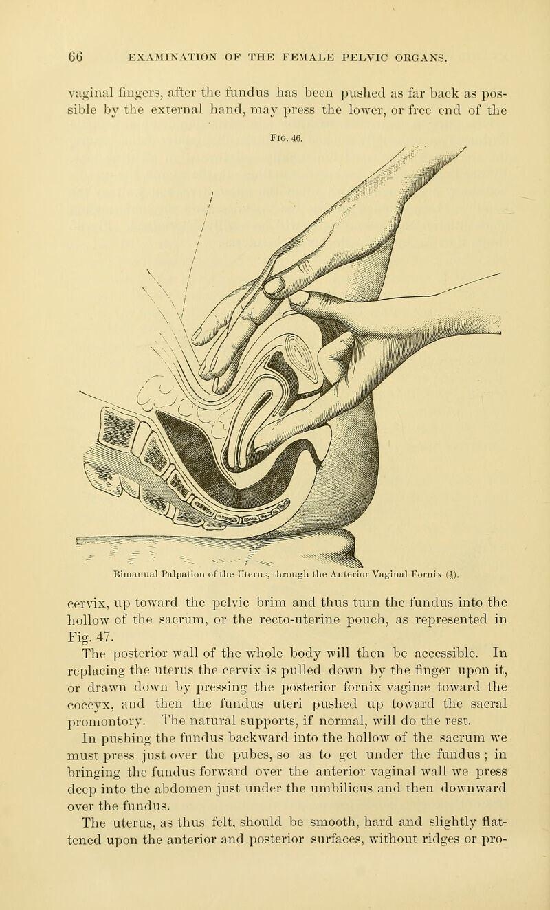 vaginal fingers, after tlie fundus has been pushed as far back as pos- sible by the external hand, may press the lower, or free end of the Fig. 46. Bimanual Palpation of the Uterus, through the Anterior Vaginal Fornix (J) cervix, up toward the pelvic brim and thus turn the fundus into the hollow of the sacrum, or the recto-uterine pouch, as represented in Fig. 47. The posterior wall of the whole body will then be accessible. In replacing the uterus the cervix is pulled down by the finger upon it, or drawn down by pressing the posterior fornix vaginae toward the coccyx, and then the fundus uteri pushed up toAvard the sacral promontory. The natural supports, if normal, will do the rest. In pushing the fundus backward into the hollow of the sacrum we must press just over the pubes, so as to get under the fundus ; in bringing the fundus forward over the anterior vaginal wall we press deep into the abdomen just under the umbilicus and then downward over the fundus. The uterus, as thus felt, should be smooth, hard and slightly flat- tened upon the anterior and posterior surfaces, without ridges or pro-