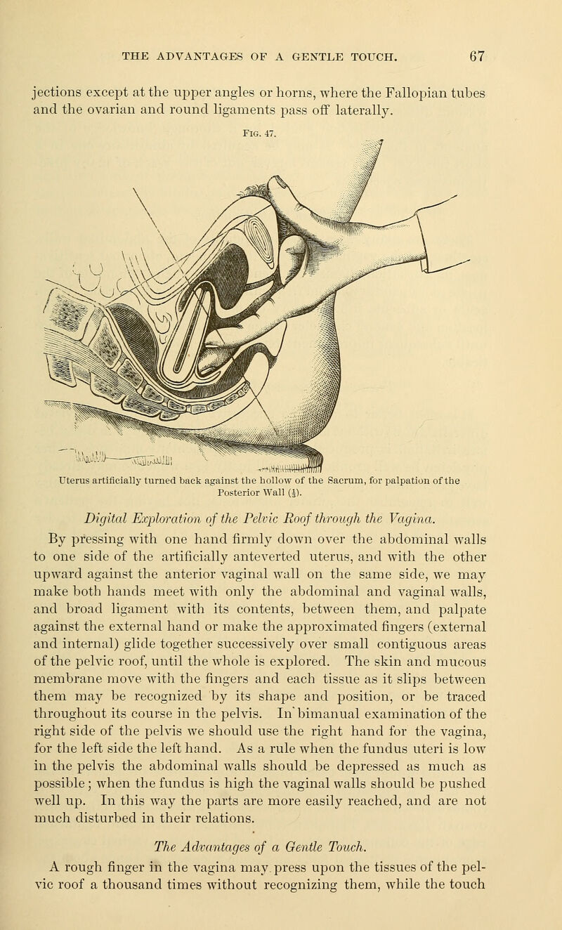 jections except at the upper angles or horns, where the Fallopian tubes and the ovarian and round ligaments pass off laterally. Fig. 47. uterus artificially turned back against the hoUow of the Sacrum, for ; Posterior Wall (i). ion of the Digital Exploration of the Pelvic Roof through the Vagina. By pressing with one hand firmly down over the abdominal walls to one side of the artificially anteverted uterus, and with the other upward against the anterior vaginal wall on the same side, we may make both hands meet with only the abdominal and vaginal walls, and broad ligament with its contents, between them, and palpate against the external hand or make the approximated fingers (external and internal) glide together successively over small contiguous areas of the pelvic roof, until the Avhole is explored. The skin and mucous membrane move with the fingers and each tissue as it slips between them may be recognized by its shape and position, or be traced throughout its course in the pelvis. In'bimanual examination of the right side of the pelvis we should use the right hand for the vagina, for the left side the left hand. As a rule when the fundus uteri is low in the pelvis the abdominal walls should be depressed as much as possible; when the fundus is high the vaginal walls should be pushed well up. In this way the parts are more easily reached, and are not much disturbed in their relations. The Advantages of a Gentle Touch. A rough finger in the vagina may. press upon the tissues of the pel- vic roof a thousand times without recognizing them, while the touch