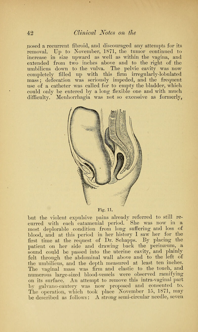 nosed a recurrent fibroid, and discouraged any attempts for its removal. Up to November, 1871, the tumor continued to increase in size upward as well as within the vagina, and extended from two inches above and to the right of the umbilicus down to the vulva. The pelvic cavity was now completely filled up with this firm irregularly-lobulated mass; defecation was seriously impeded, and the frequent use of a catheter was called for to empty the bladder, which could only be entered by a long flexible one and with much difliculty. Menhorrhagia was not so excessive as formerly. Fig. 11. but the violent expulsive pains ah-eady referred to still re- curred with each catamenial period. She was now in a most deplorable condition from long suffering and loss of blood, and at this period in her history I saw her for the first time at the request of Dr. Schapps. By placing the patient on her side and drawing back the perinfeum, a sound could be passed into the uterine cavity, and plainly felt through the abdominal wall above and to the left of the uml)ilicus, and the depth measured at least ten inches. The vaginal mass was firm and elastic to the touch, and numerous large-sized blood-vessels were observed ramifying on its surface. An attempt to remove this intra-vaginal part by galvano-cautery was now projwsed and consented to. The operation, wl'iich took place November 15, 1871, may be described as follows: A strong semi-circular needle, seven