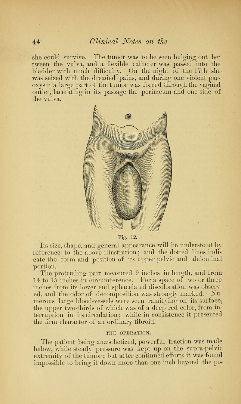 she could survive. Tlie tumor was to be seen bulging out be- tween the vulva, and a flexible catheter was passed into the bladder with much difhculty. On the night of the 17th she was seized with the dreaded pains, and during one violent par- oxysm a large part of the tumor was forced through the vaginal outlet, lacerating in its passage the perinseum and one side of the vulva. Fig. 12. Its size, shajje, and general appearance will be understood by reference to the above illustration; and the dotted lines indi- cate the form and position of its upper pelvic and abdominal portion. The protruding part measured 9 inches in length, and from 14 to 15 inches in circumference. For a space oi two or three inches from its lower end sphacelated discoloration was observ- ed, and the odor of decomposition was strongly marked. JSIu- merous large blood-vessels were seen ramifying on its surface, the up])er two-thirds of which was of a deep red color, from in- terruption in its circulation : while in consistence it presented the lirm character of an ordinary fibroid. THE OPEEATION. The patient being anaesthetized, powerful traction was made below, wliile steady pressure was kept \\\y on the supra-pelvic extremity of the tumor ; but after continued efforts it was fomid impossible to bring it down more than one inch beyond the po-