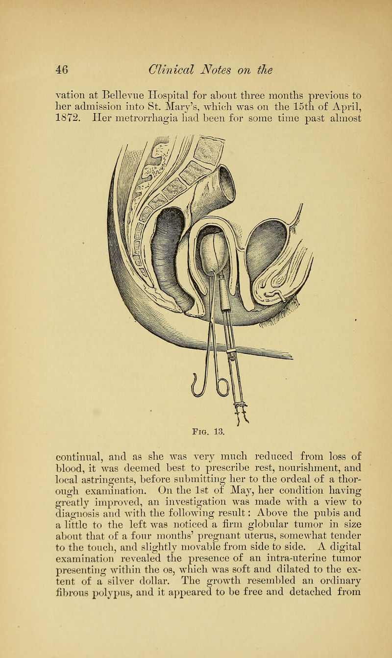 vation at Bellevne Hospital for about three months previous to her admission into St. Mary's, which was on the 15th of April, 1872. J-Ier metrorrhagia had been for some time past almost Fig. 13. continual, and as she was very mnch reduced from loss of blood, it was deemed best to prescribe rest, nourishment, and local astringents, before submitting her to the ordeal of a thor- ough examination. On the Ist of May, her condition having greatly improved, an investigation was made with a view to diagnosis and with the following result: Above the pubis and a little to the left was noticed a firm globular tumor in size about that of a four months' pregnant uterus, somewhat tender to the touch, and slightly movable from side to side. A. digital examination revealed the presence of an intra-uterine tumor presenting witliin the os, which Avas soft and dilated to the ex- tent of a silver dollar. The growth resembled an ordinary fibrous polypus, and it appeared to be free and detached from