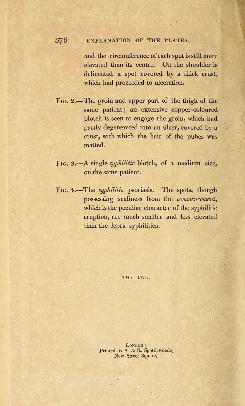 and the circumference of each spot is still more elevated than its centre. On the shoulder is delineated a spot covered by a thick crust, which had proceeded to ulceration. Fig. 2.—The groin and upper part of the thigh of the same patient; an extensive copper-coloured blotch is seen to engage the groin, which had partly degenerated into an ulcer, covered by a crust, with which the hair of the pubes was matted. Fig. 3.—A single syphilitic blotch, of a medium size, on the same patient. Fig. 4<.—The syphilitic psoriasis. The spots, though possessing scaliness from the commencementy which is the peculiar character of the syphilitic eruption, are much smaller and less elevated than the lepra syphilitica. THE END, London : Printed by A. & R. Spottlswoodej New-Street- Square,
