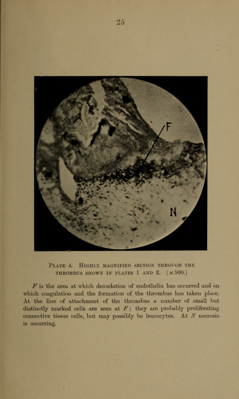 2o Plate 4. Highly magnified section through the thrombus shown in plates 1 and 2. ( x 500.) F is the area at which denudation of endothelia has occurred and on which coagulation and the formation of the thrombus has taken place. At the line of attachment of the thrombus a number of small but distinctly marked cells are seen at F; they are probably proliferating connective tissue cells, but may possibly be leucocytes. At N necrosis is occurring.