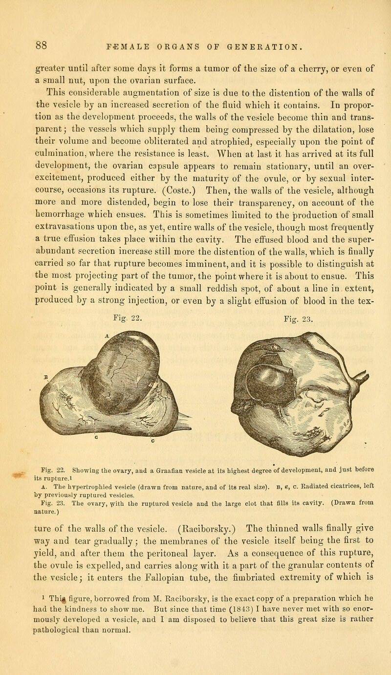 greater until after some days it forms a tumor of the size of a cherry, or even of a small nut, upon the ovarian surface. This considerable augmentation of size is due to the distention of the walls of the vesicle by an increased secretion of the fluid which it contains. In propor- tion as the development proceeds, the walls of the vesicle become thin and trans- parent; the vessels which supply them being compressed by the dilatation, lose their volume and become obliterated and atrophied, especially upon the point of culmination, where the resistance is least. When at last it has arrived at its full development, the ovarian capsule appears to remain stationary, until an over- excitement, produced either by the maturity of the ovule, or by sexual inter- course, occasions its rupture. (Coste.) Then, the walls of the vesicle, although more and more distended, begin to lose their transparency, on account of the hemorrhage which ensues. This is sometimes limited to the production of small extravasations upon the, as yet, entire walls of the vesicle, though most frequently a true effusion takes place within the cavity. The effused blood and the super- abundant secretion increase still more the distention of the walls, which is finally carried so far that rupture becomes imminent, and it is possible to distinguish at the most projecting part of the tumor, the point where it is about to ensue. This point is generally indicated by a small reddish spot, of about a line in extent, produced by a strong injection, or even by a slight effusion of blood in the tex- Fig. 22. Fig. 23. Fig. 22. Showing the ovary, and a Graafian vesicle at its highest degree of development, and just before its rupture.l A. The hypertrophied vesicle (drawn from nature, and of its real size), b, e, c. Radiated cicatrices, left by previously ruptured vesicles. Fig. 23. The ovary, with the ruptured vesicle and the large clot that fills its cavity. (Drawn from nature.) ture of the walls of the vesicle. (Raciborsky.) The thinned walls finally give way and tear gradually; the membranes of the vesicle itself being the first to yield, and after them the peritoneal layer. As a consequence of this rupture, the ovule is expelled, and carries along with it a part of the granular contents of the vesicle; it enters the Fallopian tube, the fimbriated extremity of which is 1 Thi^ figure, borrowed from M. Raciborsky, is the exact copy of a preparation which he had the kindness to show me. But since that time (1843) I have never met with so enor- mously developed a vesicle, and I am disposed to believe that this great size is rather pathological than normal.