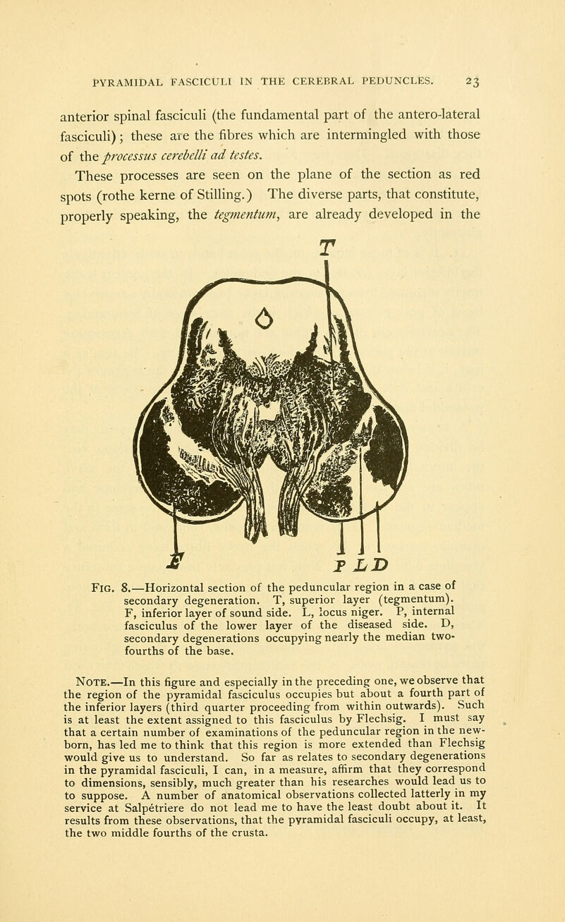 anterior spinal fasciculi (the fundamental part of the antero-lateral fasciculi); these are the fibres which are intermingled with those of the processus cerebelli ad testes. These processes are seen on the plane of the section as red spots (rothe kerne of Stilling.) The diverse parts, that constitute, properly speaking, the tegmentum, are already developed in the Fig. 8.—Horizontal section of the peduncular region in a case of secondary degeneration. T, superior layer (tegmentum). F, inferior layer of sound side. L, locus niger. P, internal fasciculus of the lower layer of the diseased side. D, secondary degenerations occupying nearly the median two- fourths of the base. Note.—In this figure and especially in the preceding one, we observe that the region of the pyramidal fasciculus occupies but about a fourth part of the inferior layers (third quarter proceeding from within outwards). Such is at least the extent assigned to this fasciculus by Flechsig. I must say that a certain number of examinations of the peduncular region in the new- born, has led me to think that this region is more extended than Flechsig would give us to understand. So far as relates to secondary degenerations in the pyramidal fasciculi, I can, in a measure, affirm that they correspond to dimensions, sensibly, much greater than his researches would lead us to to suppose. A number of anatomical observations collected latterly in my service at Salpetriere do not lead me to have the least doubt about it. It results from these observations, that the pyramidal fasciculi occupy, at least, the two middle fourths of the crusta.