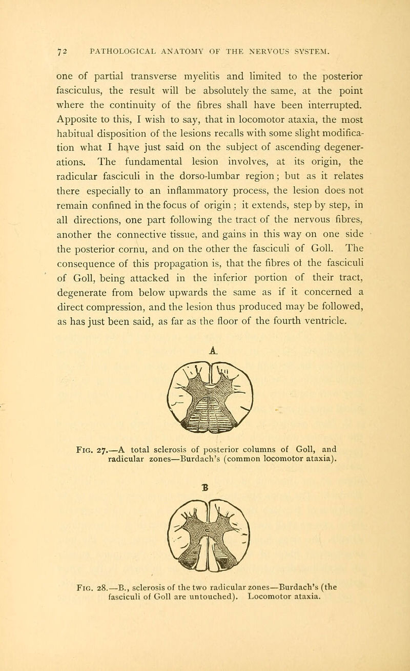 one of partial transverse myelitis and limited to the posterior fasciculus, the result will be absolutely the same, at the point where the continuity of the fibres shall have been interrupted. Apposite to this, I wish to say, that in locomotor ataxia, the most habitual disposition of the lesions recalls with some slight modifica- tion what I have just said on the subject of ascending degener- ations. The fundamental lesion involves, at its origin, the radicular fasciculi in the dorso-lumbar region; but as it relates there especially to an inflammatory process, the lesion does not remain confined in the focus of origin : it extends, step by step, in all directions, one part following the tract of the nervous fibres, another the connective tissue, and gains in this way on one side the posterior cornu, and on the other the fasciculi of Goll. The consequence of this propagation is, that the fibres ot the fasciculi of Goll, being attacked in the inferior portion of their tract, degenerate from below upwards the same as if it concerned a direct compression, and the lesion thus produced may be followed, as has just been said, as far as the floor of the fourth ventricle. Fig. 27.—A total sclerosis of posterior columns of Goll, and radicular zones—Burdach's (common locomotor ataxia). 3 Fig. 28.—B., sclerosis of the two radicular zones—Burdach's (the fasciculi of Goll are untouched). Locomotor ataxia.