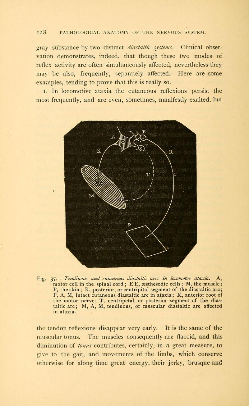 gray substance by two distinct diastaltic systems. Clinical obser- vation demonstrates, indeed, that though these two modes of reflex activity are often simultaneously affected, nevertheless they may be also, frequently, separately affected. Here are some examples, tending to prove that this is really so. I. In locomotive ataxia the cutaneous reflexions persist the most frequently, and are even, sometimes, manifestly exalted, but 37. — Tendinous and cutaneous diastaltic arcs in locomotor ataxia. A, motor cell in the spinal cord ; E E, assthesodic cells ; M, the muscle ; P, the skin ; R, posterior, or centripital segment of the diastaltic arc; P, A, M, intact cutaneous diastaltic arc in ataxia; K, anterior root of the motor nerve; T, centripetal, or posterior segment of the dias- taltic arc; M, A, M, tendinous, or muscular diastaltic arc affected in ataxia. the tendon reflexions disappear very early. It is the same of the muscular tonus. The muscles consequently are flaccid, and this diminution of tofiiis contributes, certainly, in a great measure, to give to the gait, and movements of the limbs, which conserve otherwise for along time great energy, their jerky, brusque and